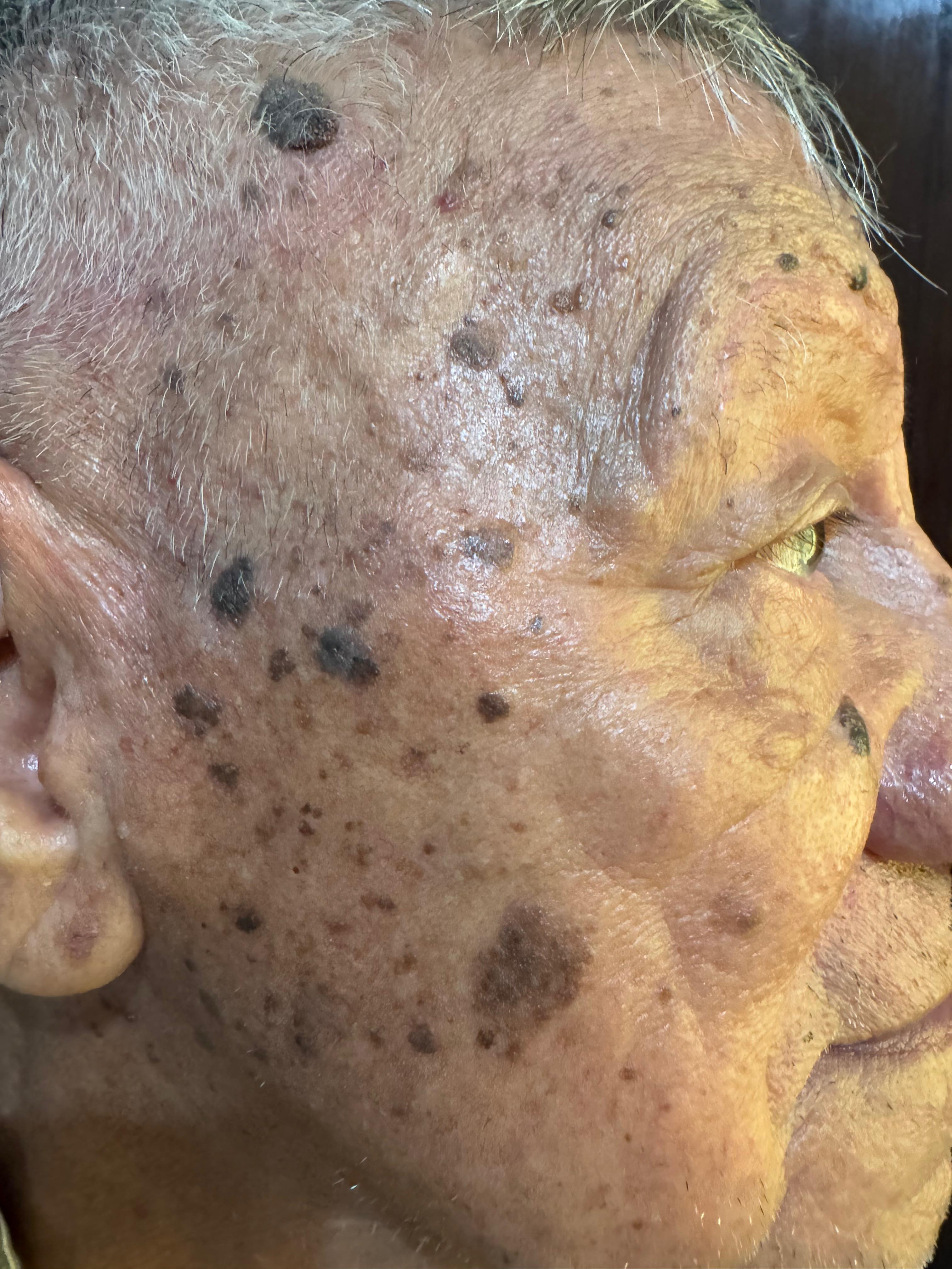 QUERATOSIS SEBORREICA