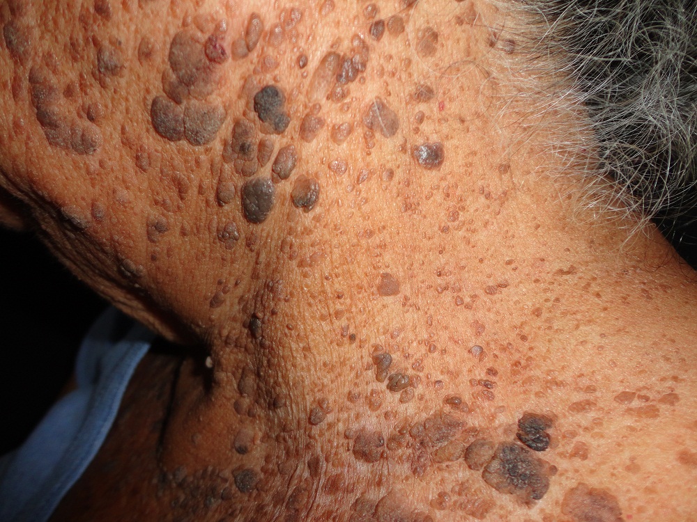 QUERATOSIS SEBORREICA