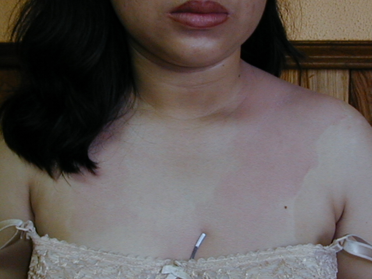 PITIRIASIS VERSICOLOR