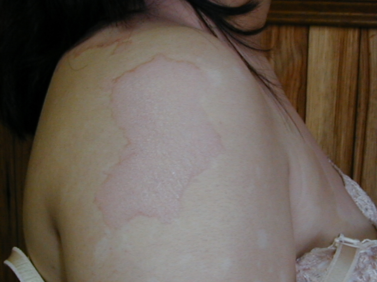 PITIRIASIS VERSICOLOR