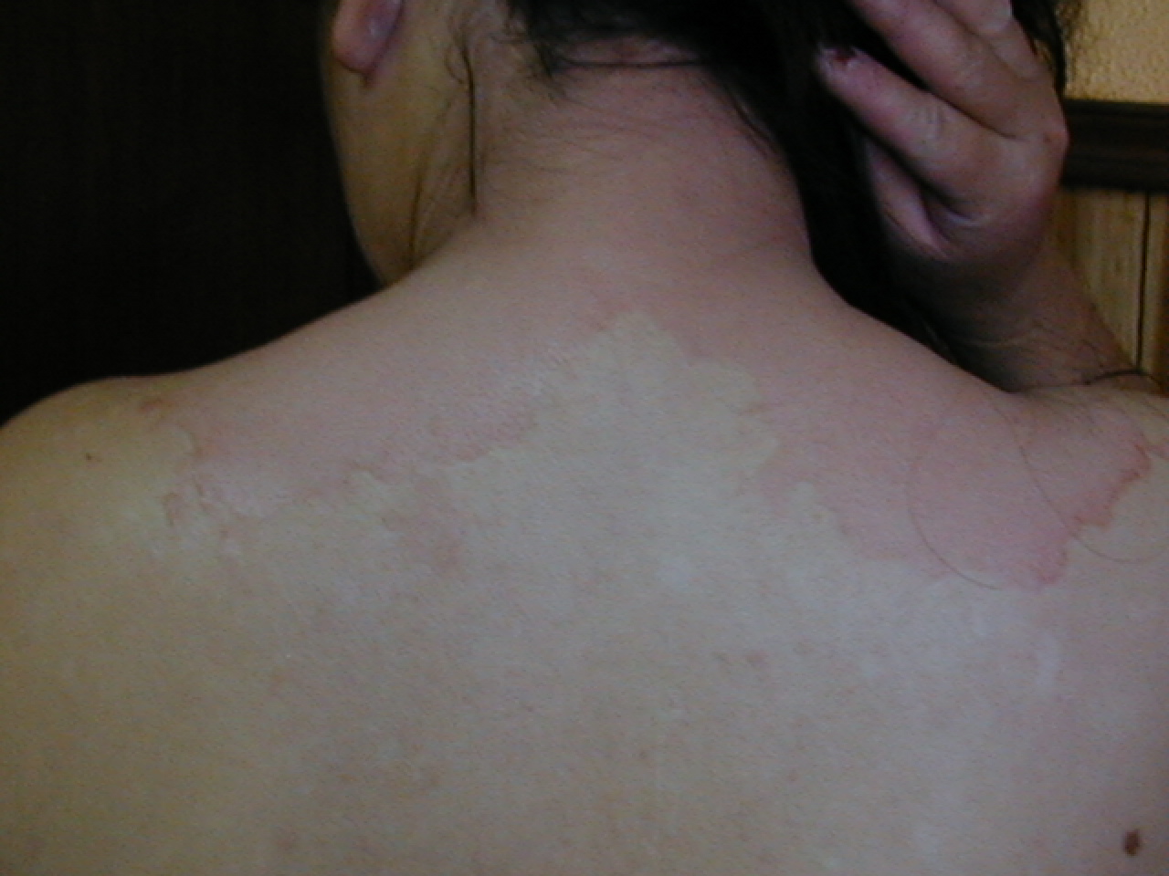 PITIRIASIS VERSICOLOR