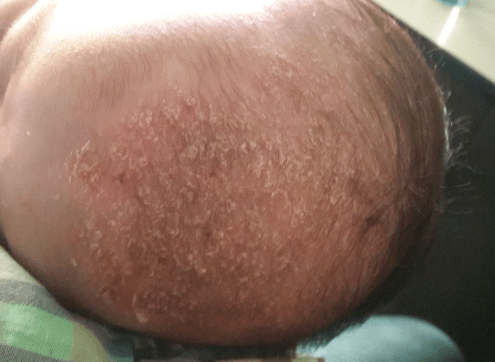 DERMATITIS SEBORREICA INFANTIL