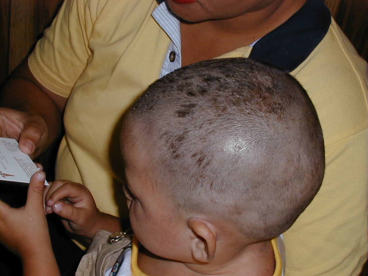 DERMATITIS SEBORREICA INFANTIL