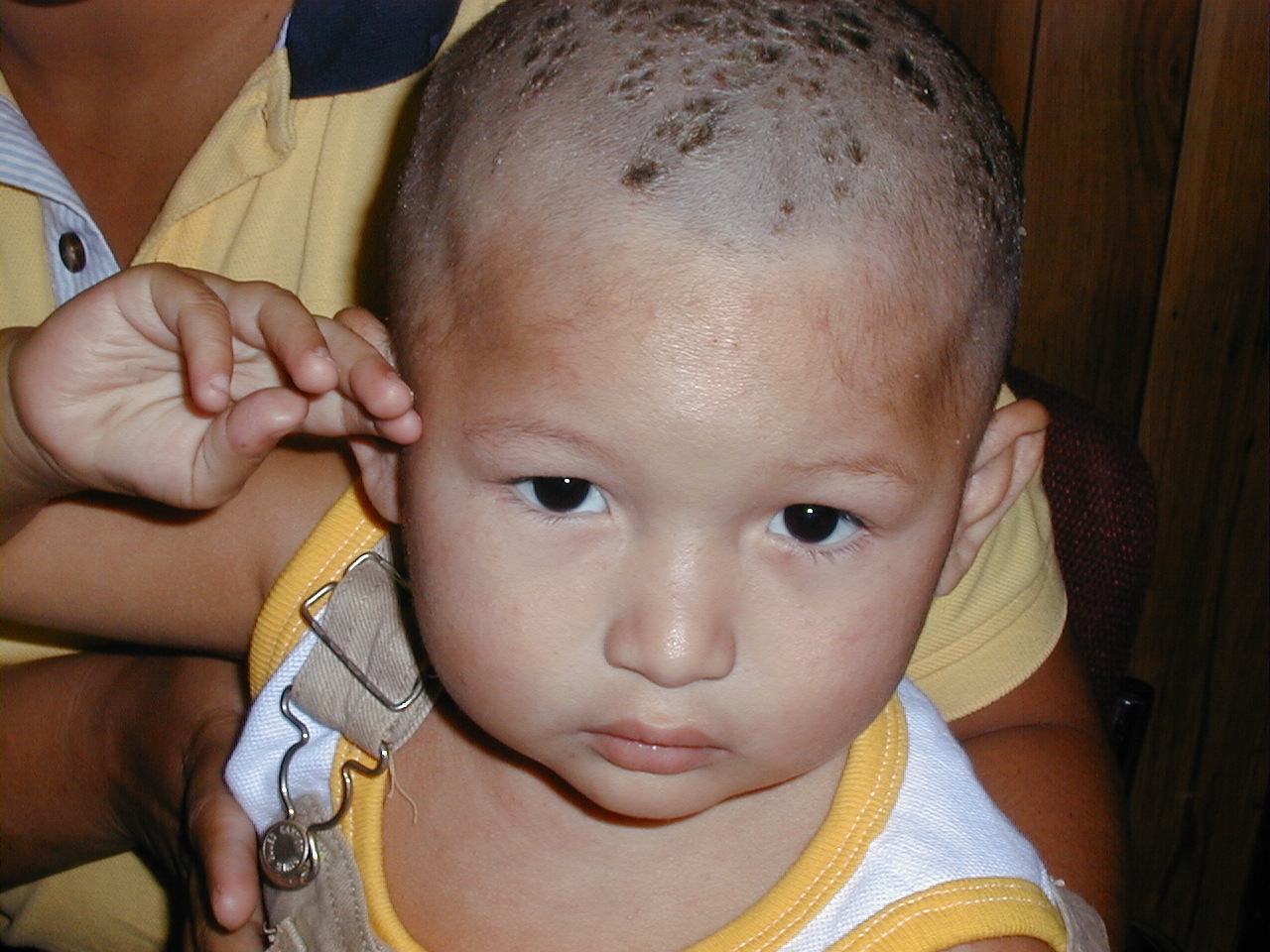 DERMATITIS SEBORREICA INFANTIL