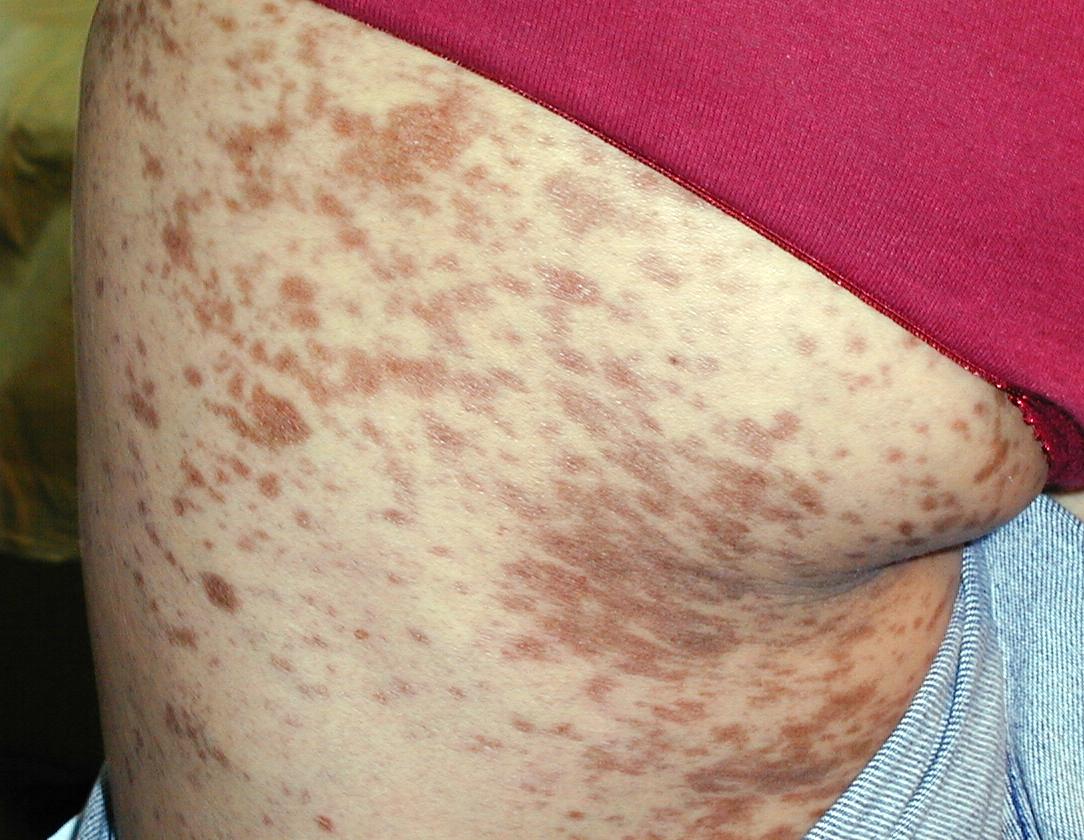 LIQUEN PLANO- Hipercromia post lesional