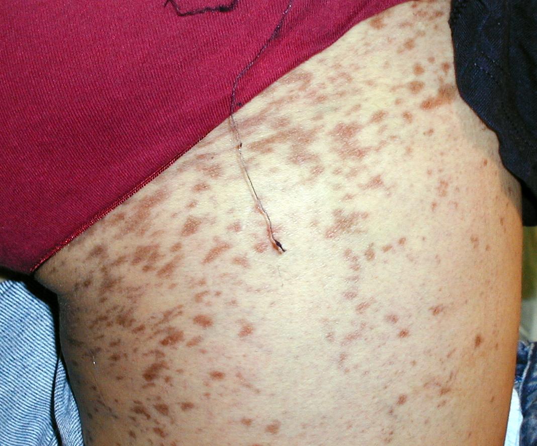 LIQUEN PLANO- Hipercromia post lesional