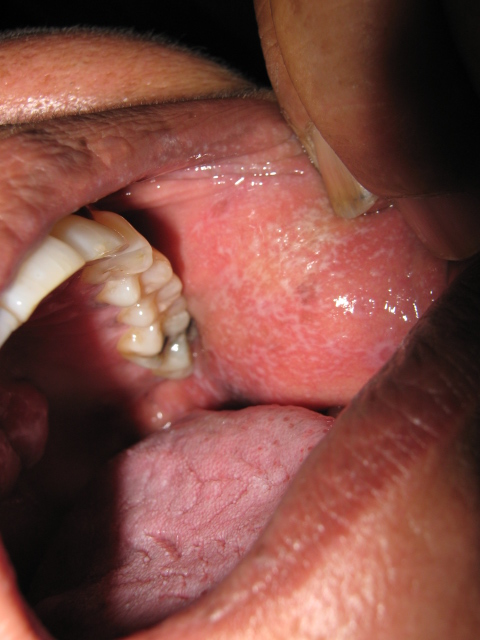 LIQUEN PLANO ORAL
