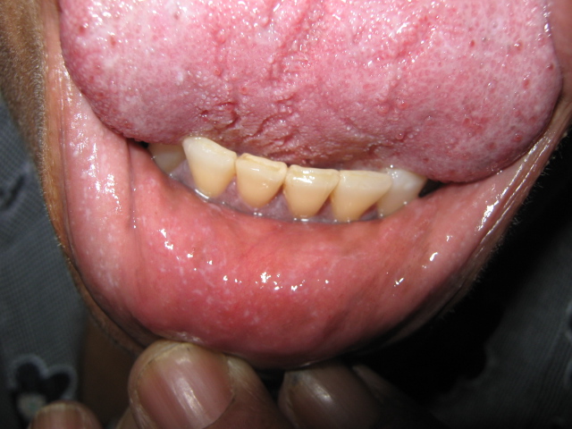 LIQUEN PLANO ORAL