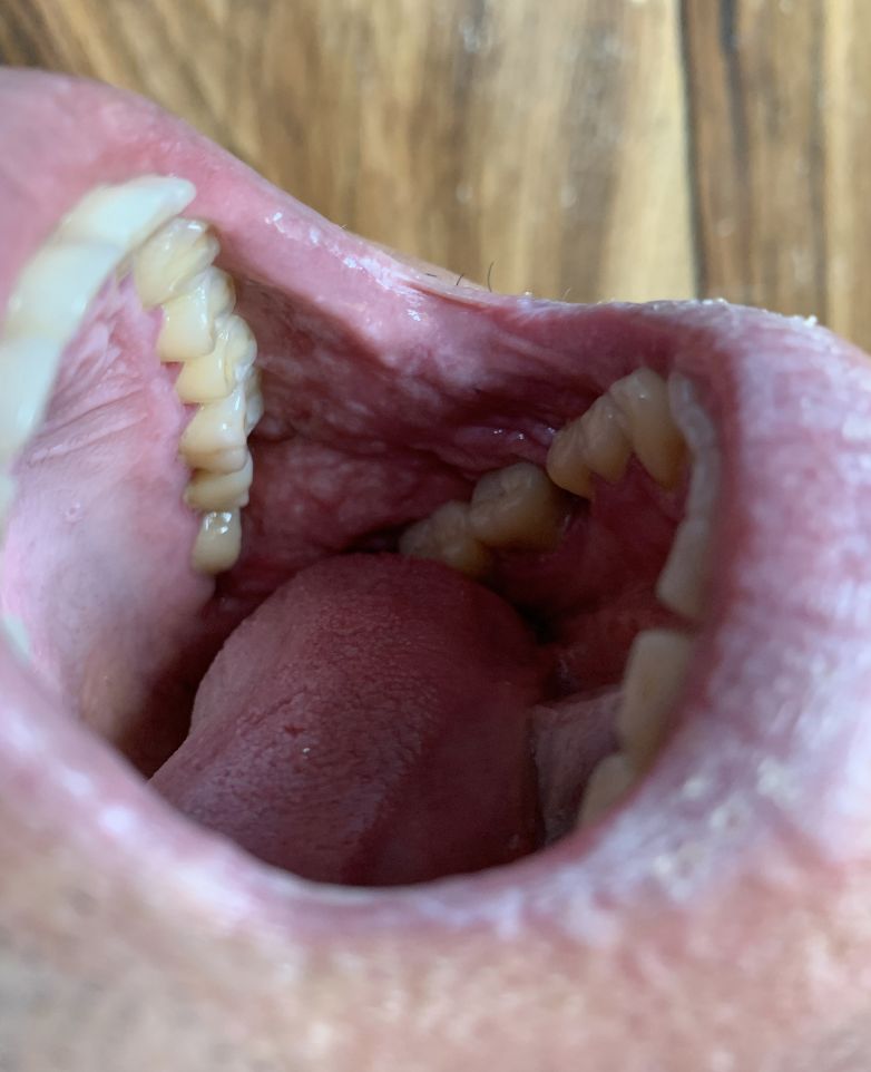 LIQUEN PLANO ORAL