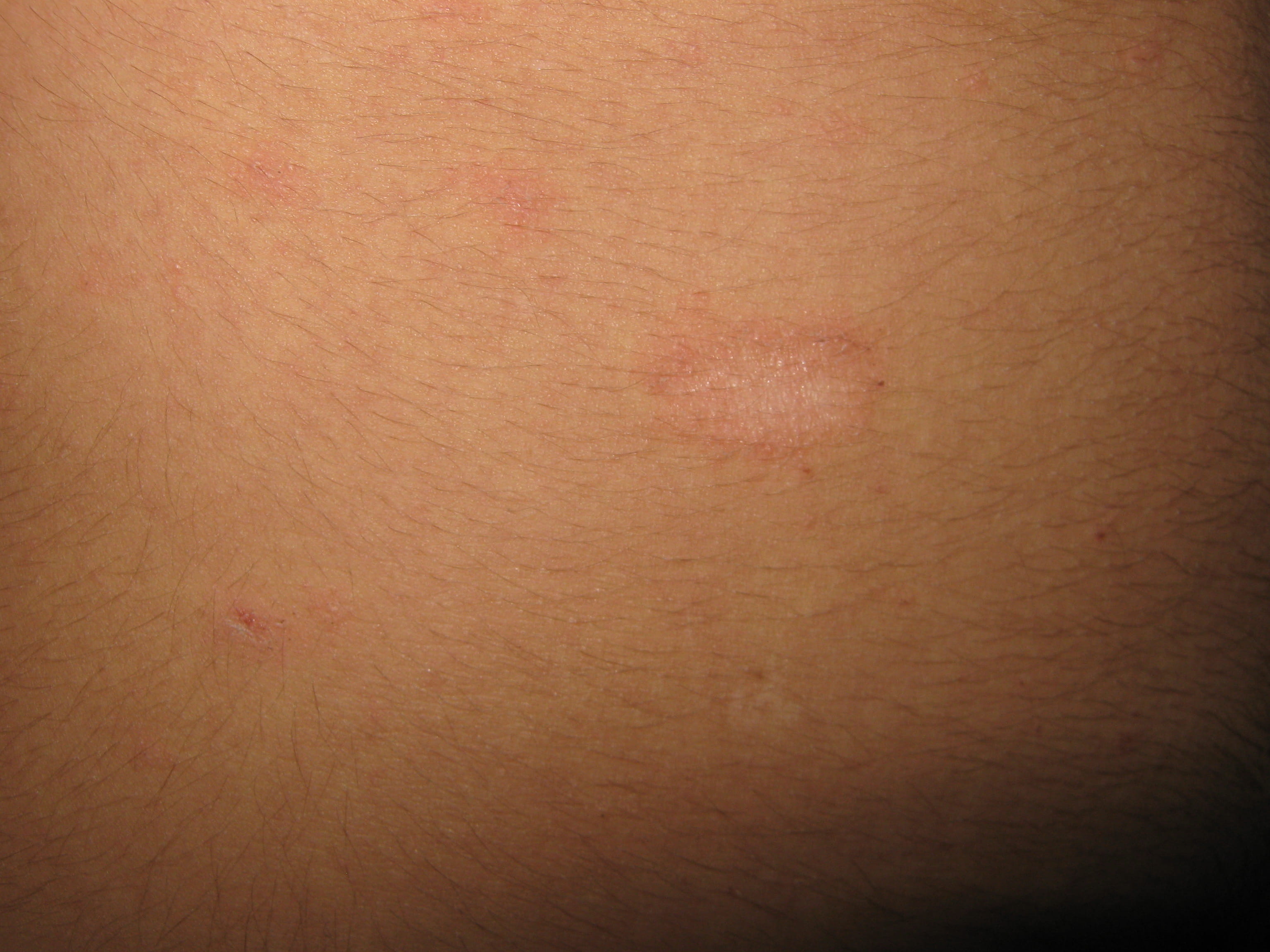 PITIRIASIS ROSADA - Medallon Heráldico