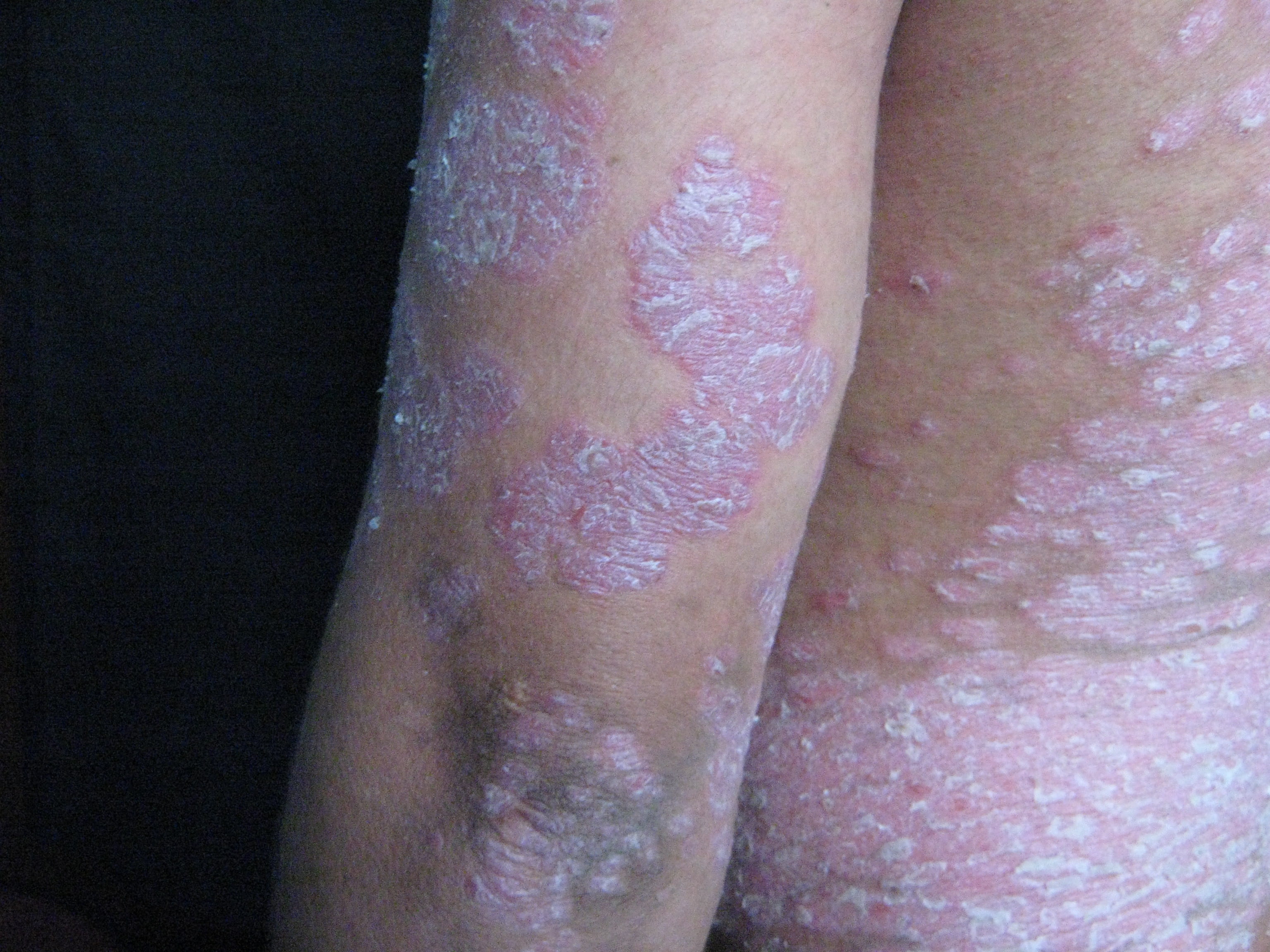 PSORIASIS