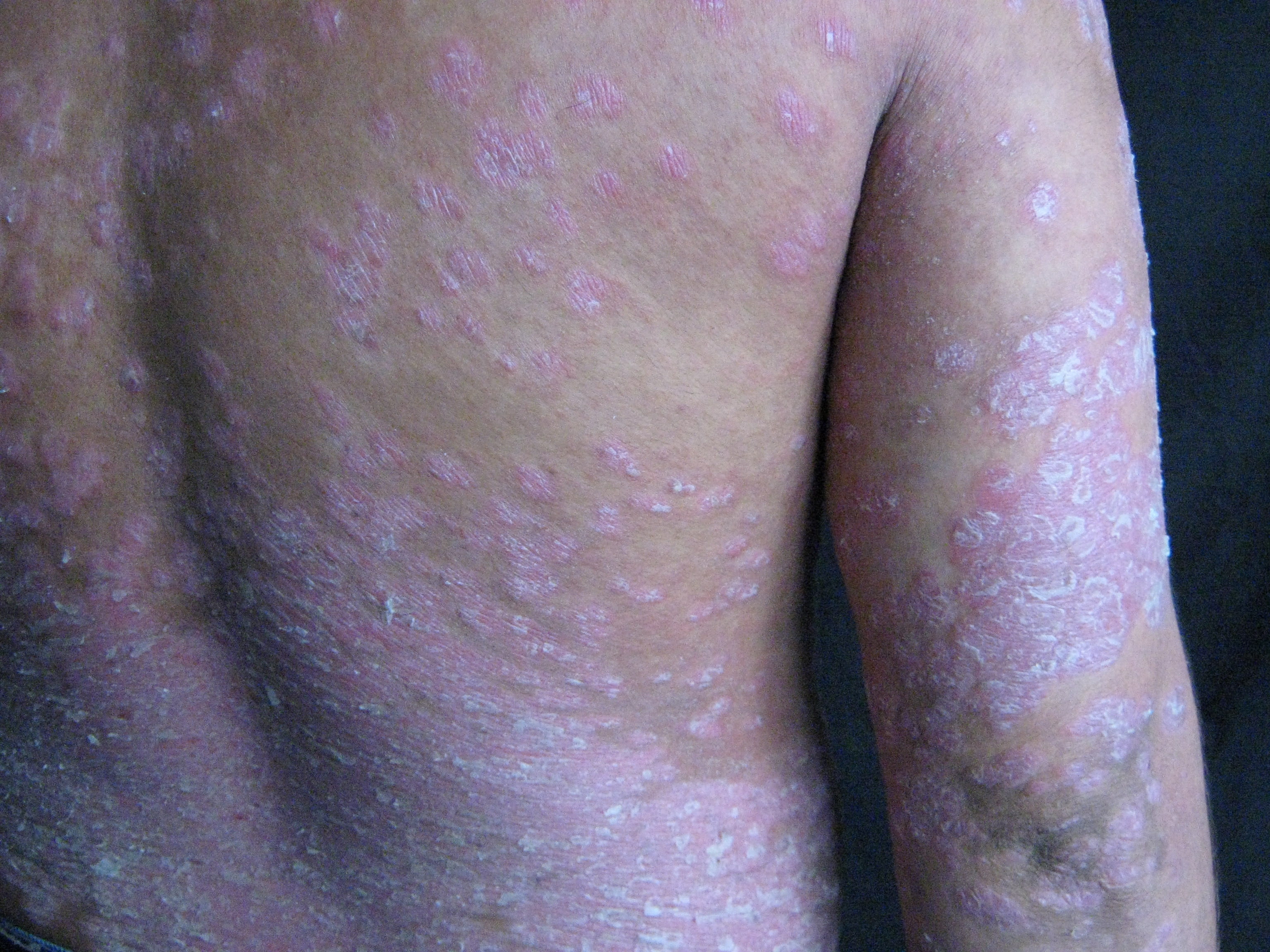 PSORIASIS