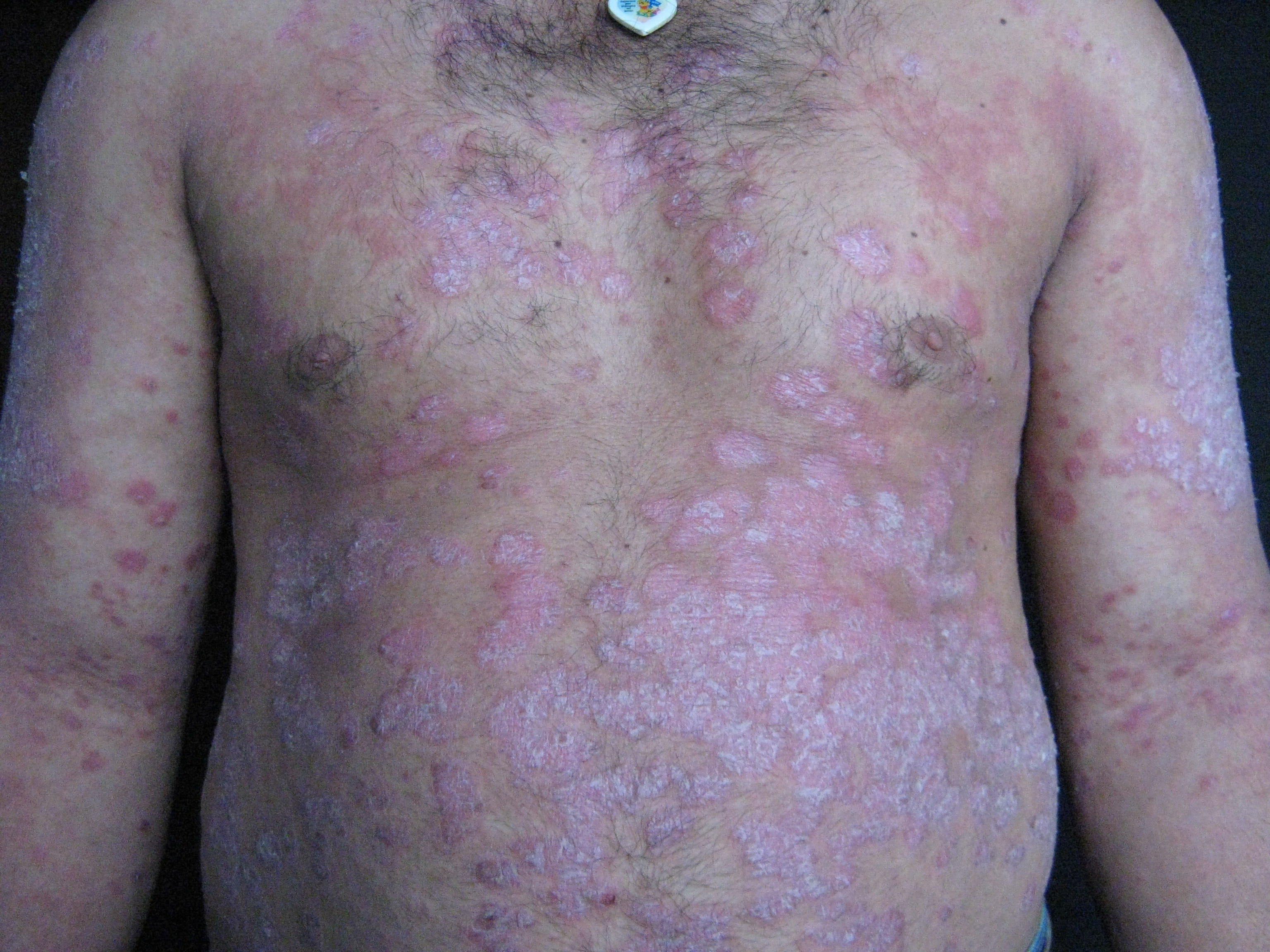 PSORIASIS