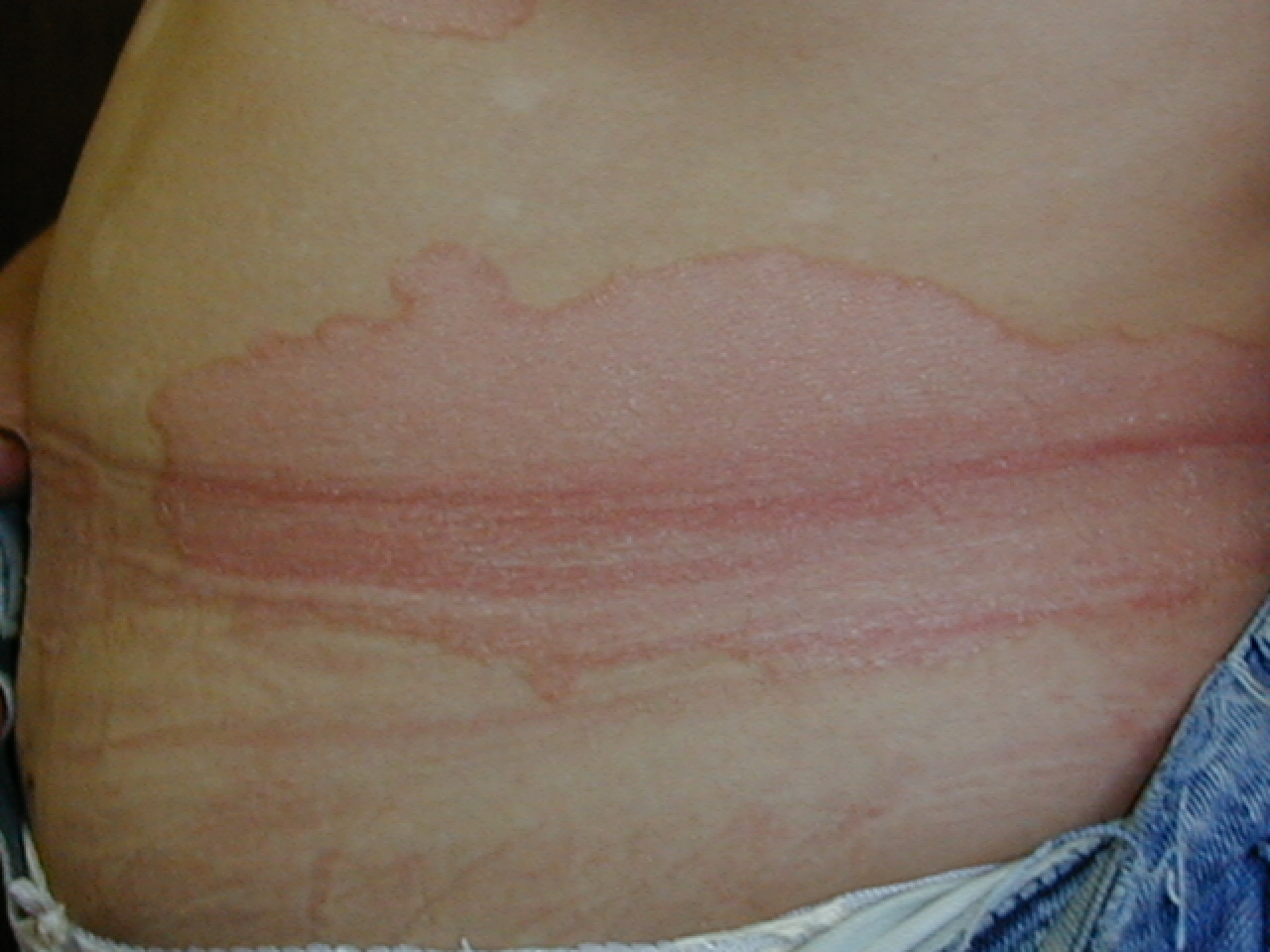 PSORIASIS