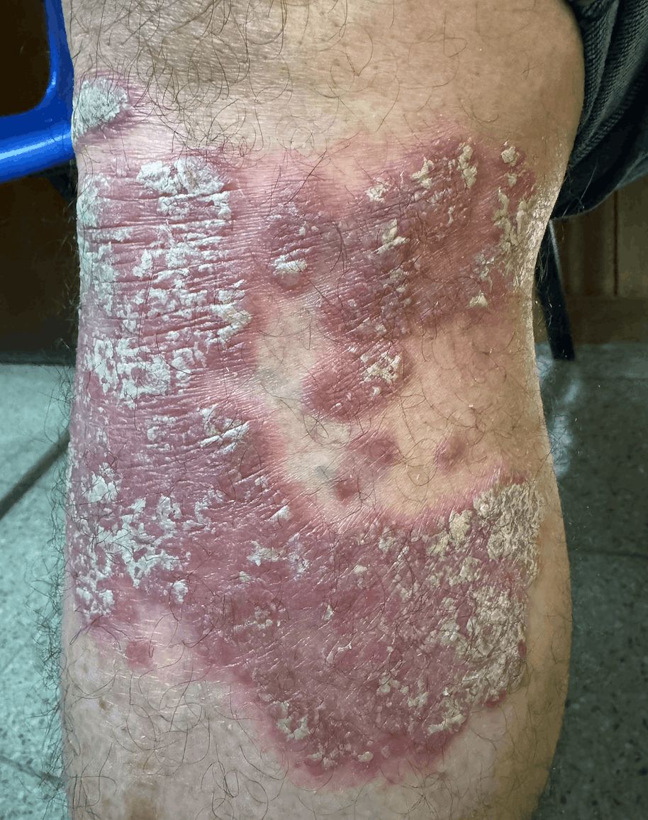 PSORIASIS