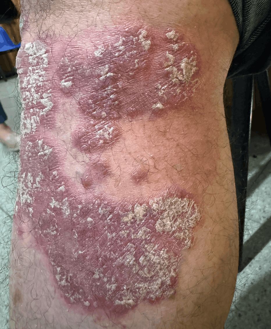 PSORIASIS