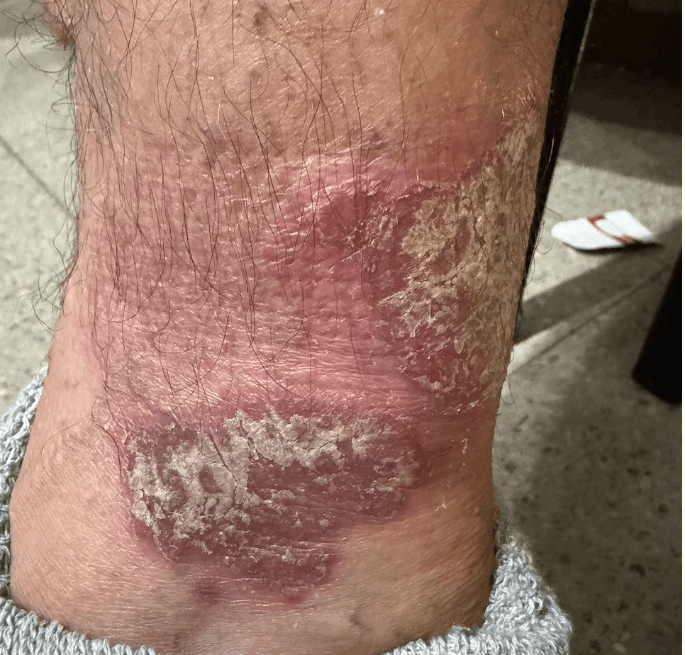 PSORIASIS