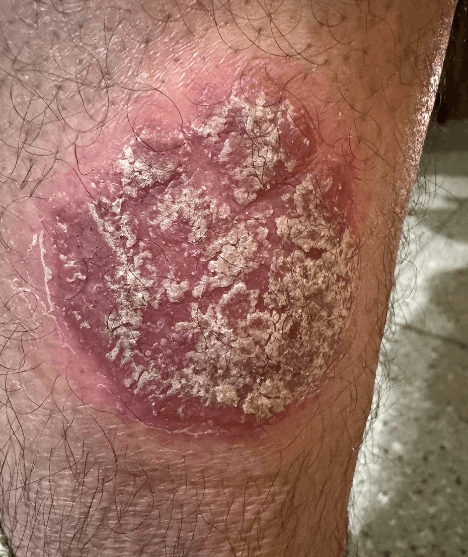 PSORIASIS - Plqaca ostrácea