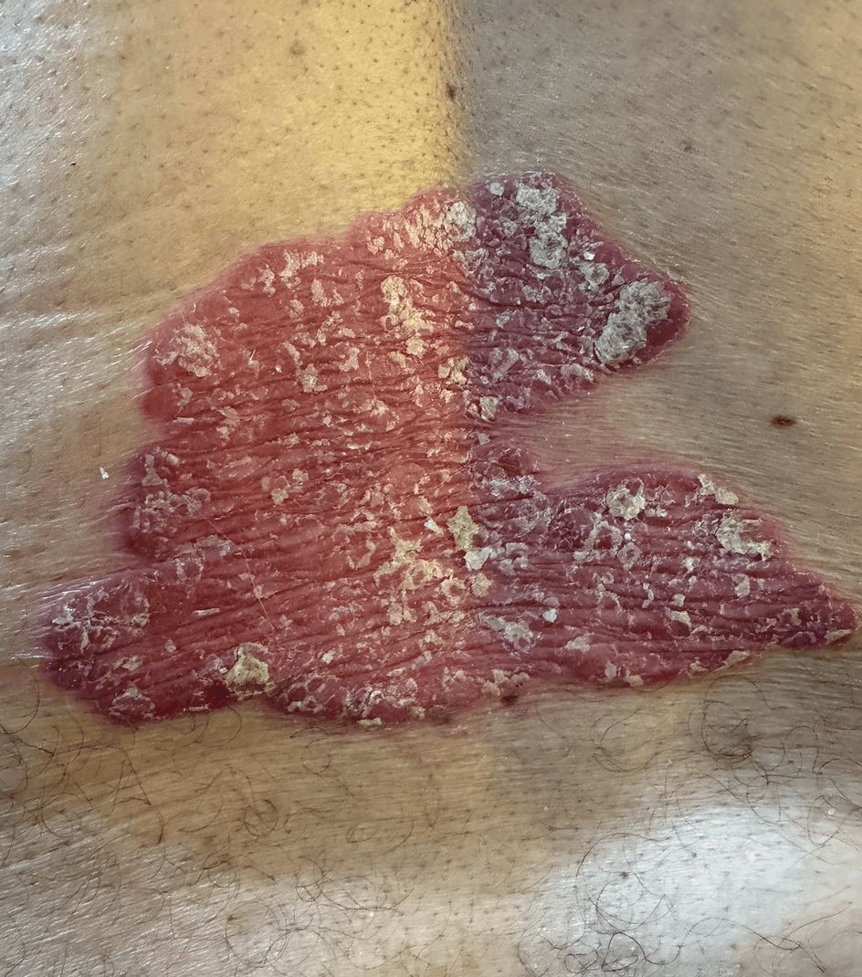 PSORIASIS - Plqaca ostrácea