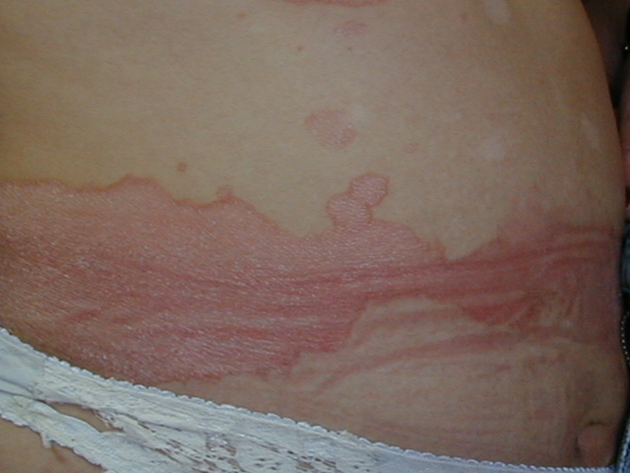 PSORIASIS