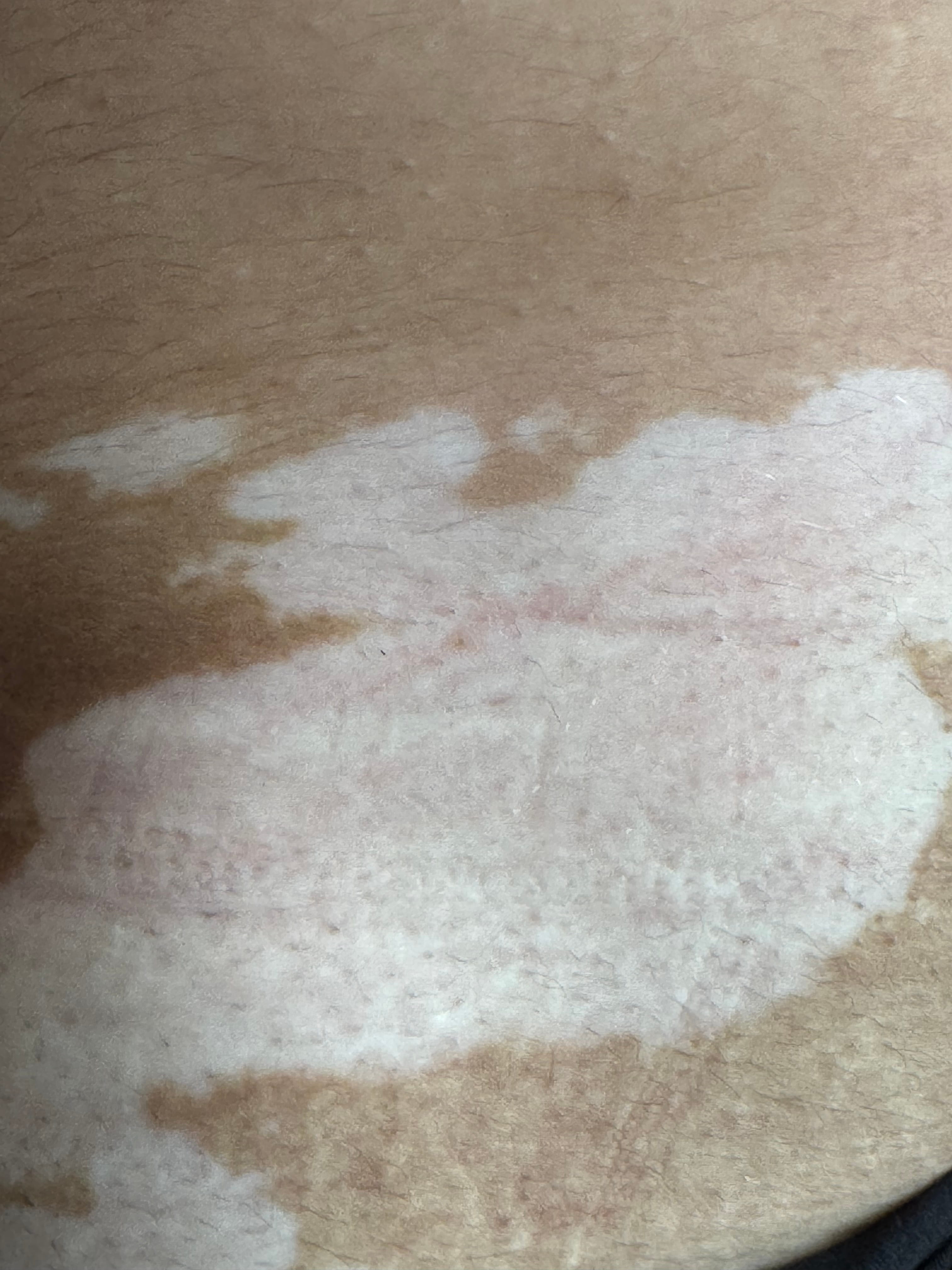 VITILIGO