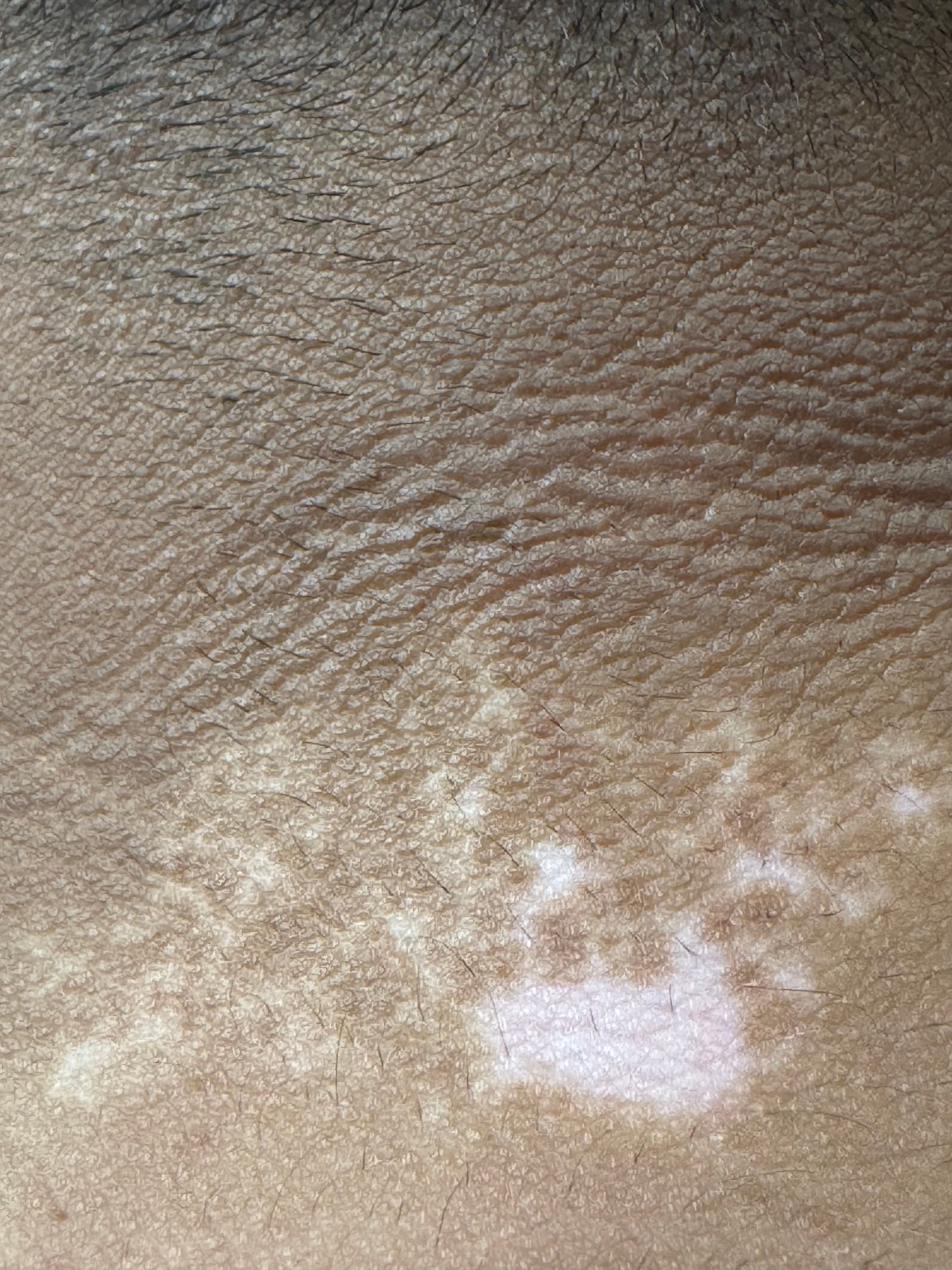 VITILIGO - Acantosis Nigricans