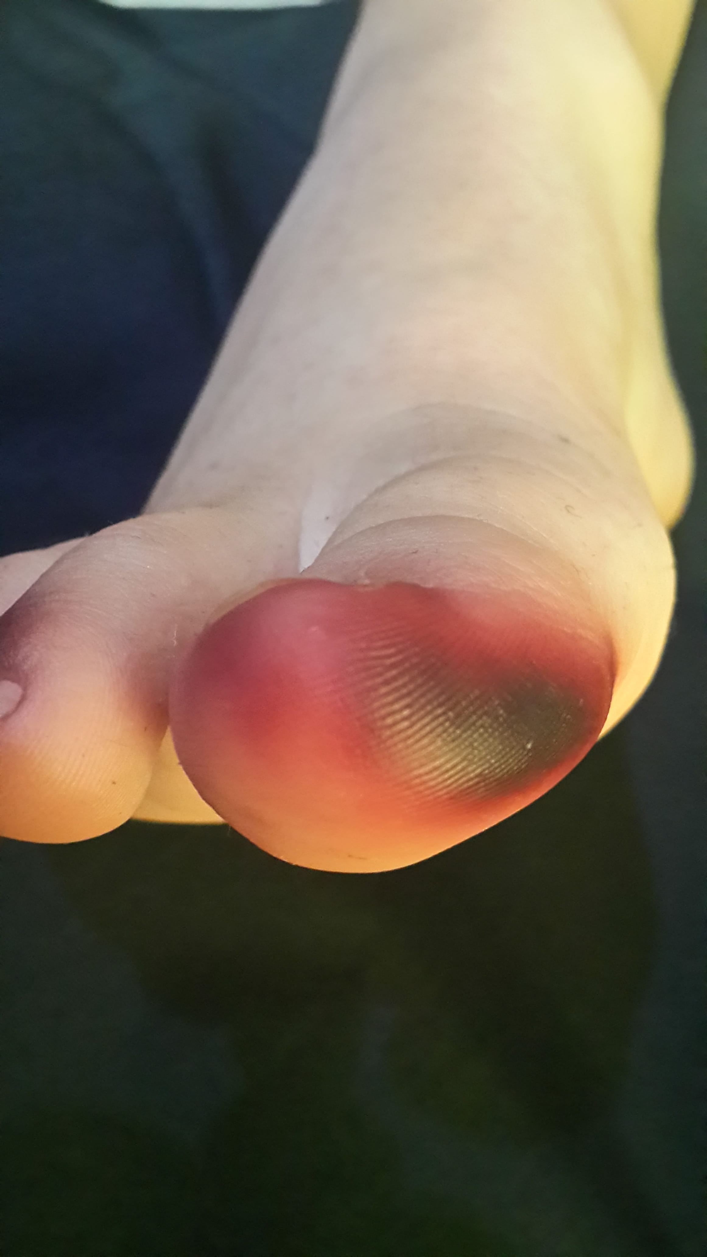 MANCHA HIPERCROMICA por colorante del calzado