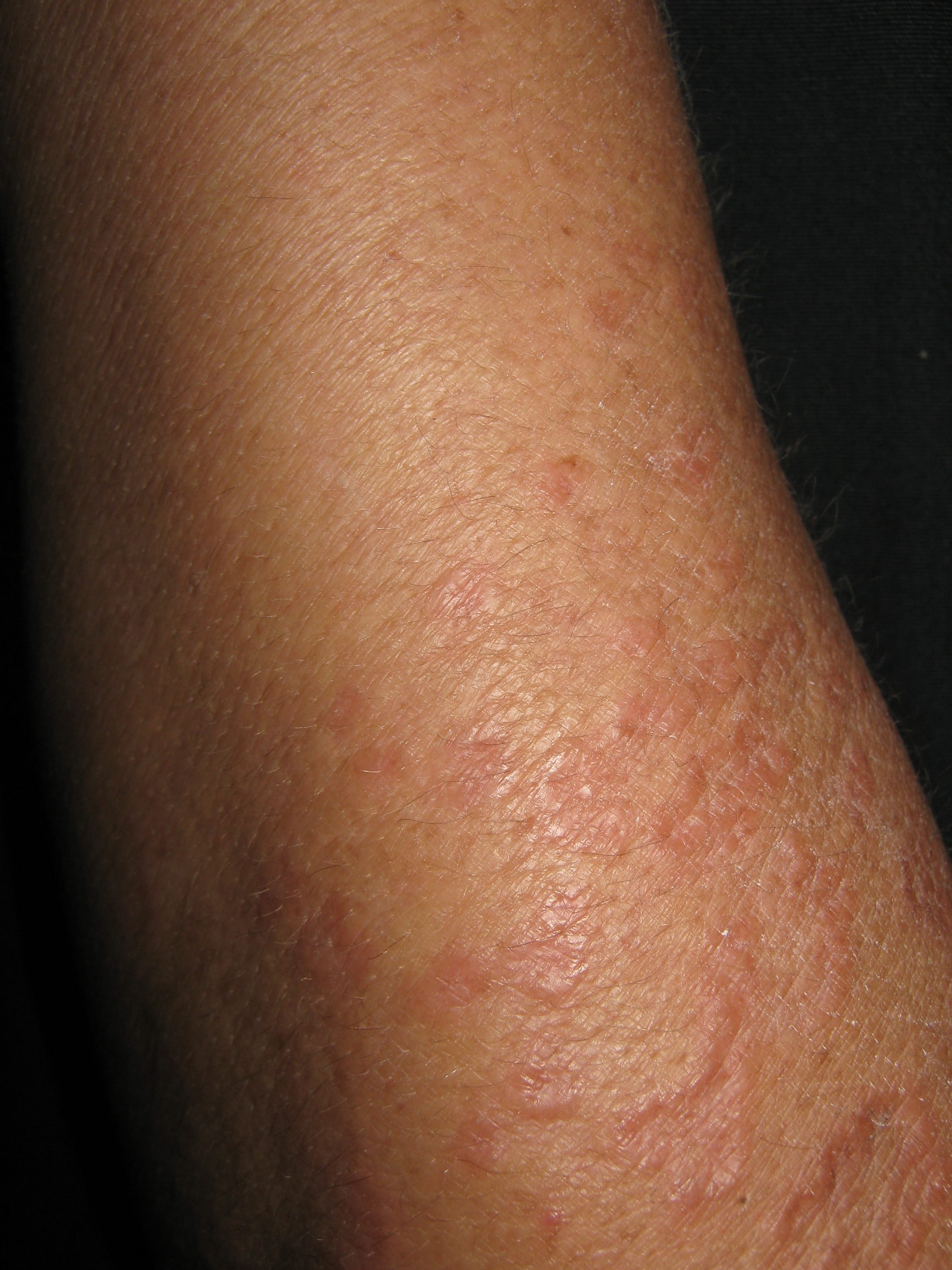 GRANULOMA ANULAR