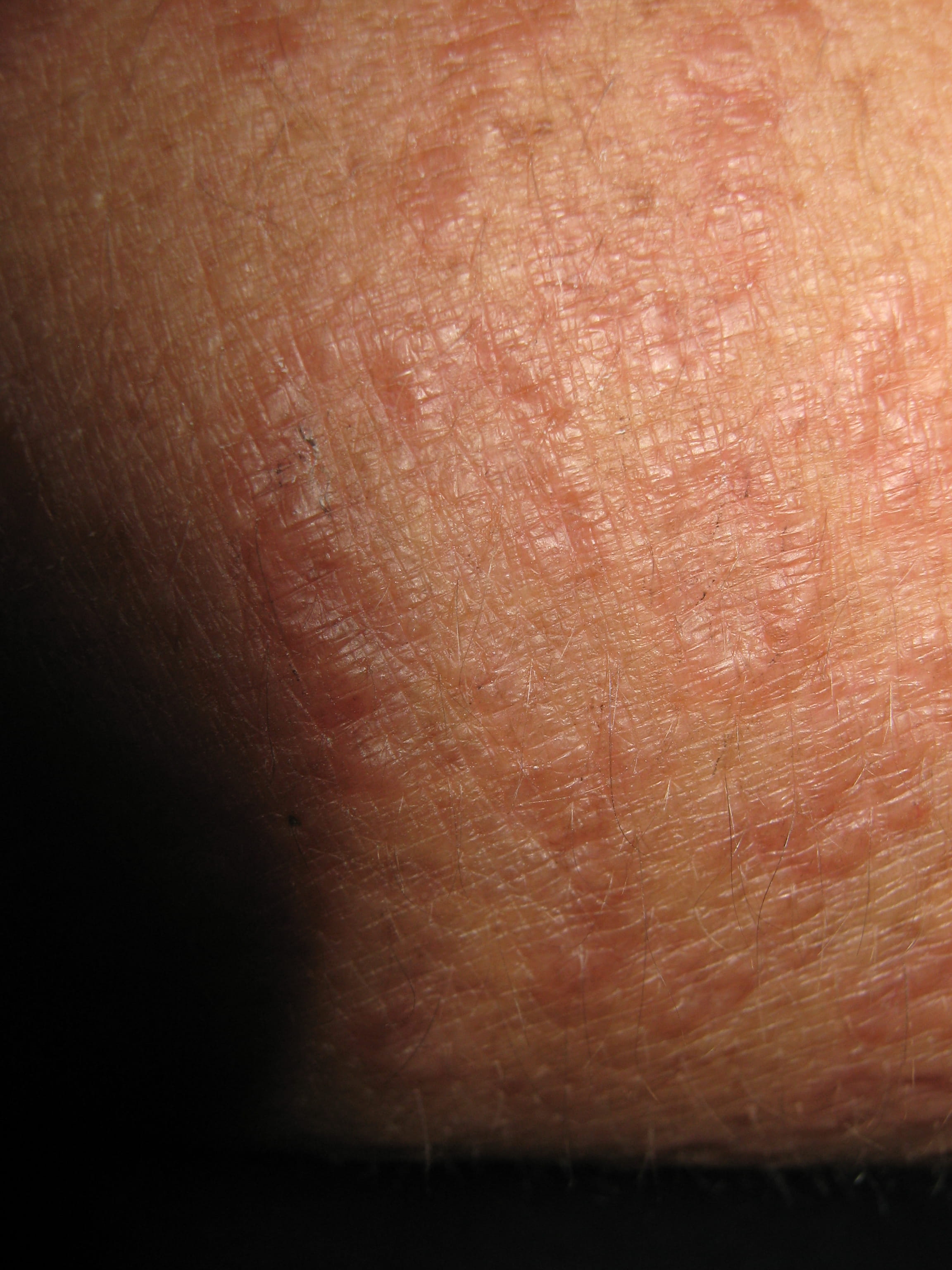 GRANULOMA ANULAR