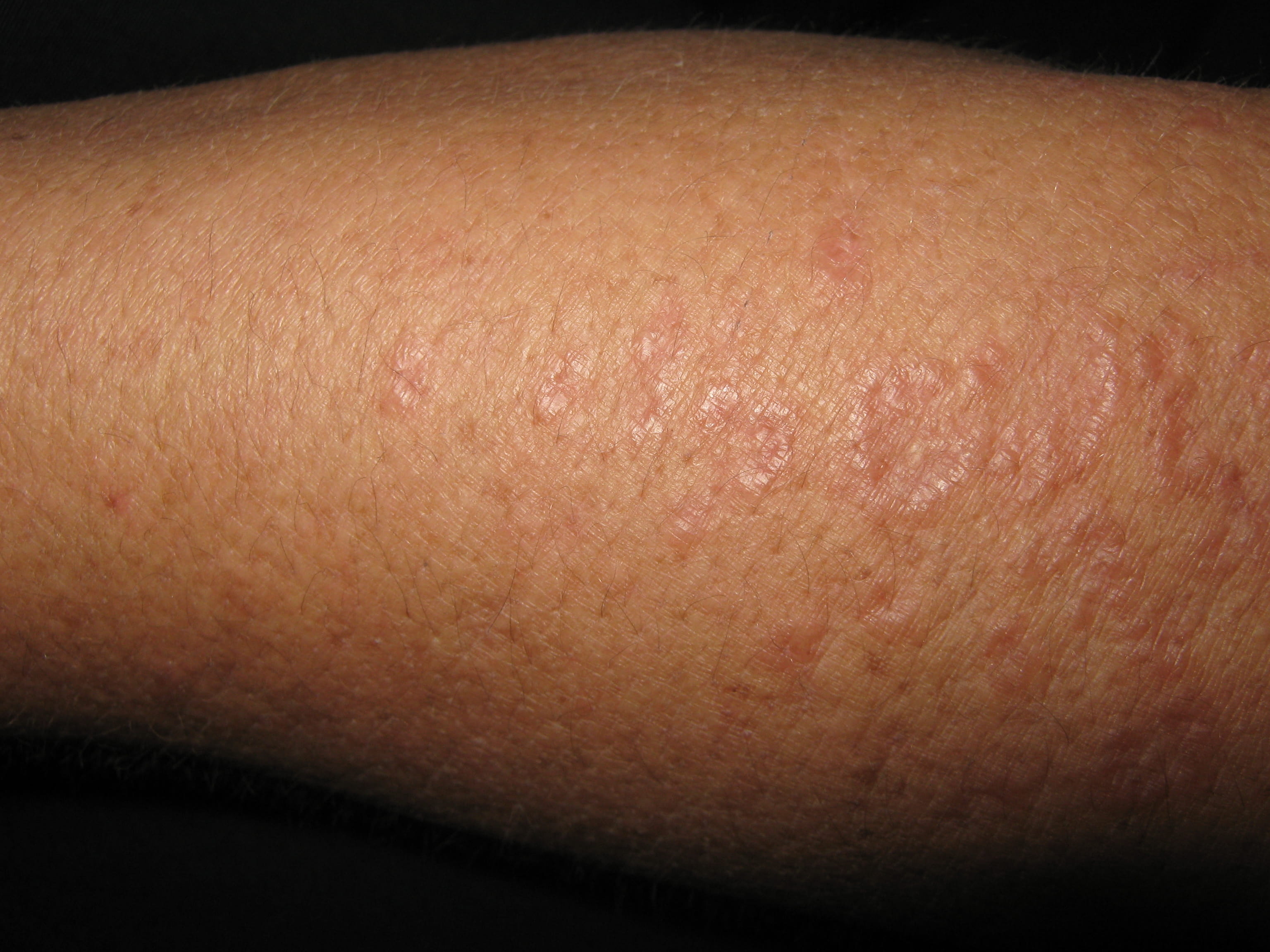 GRANULOMA ANULAR