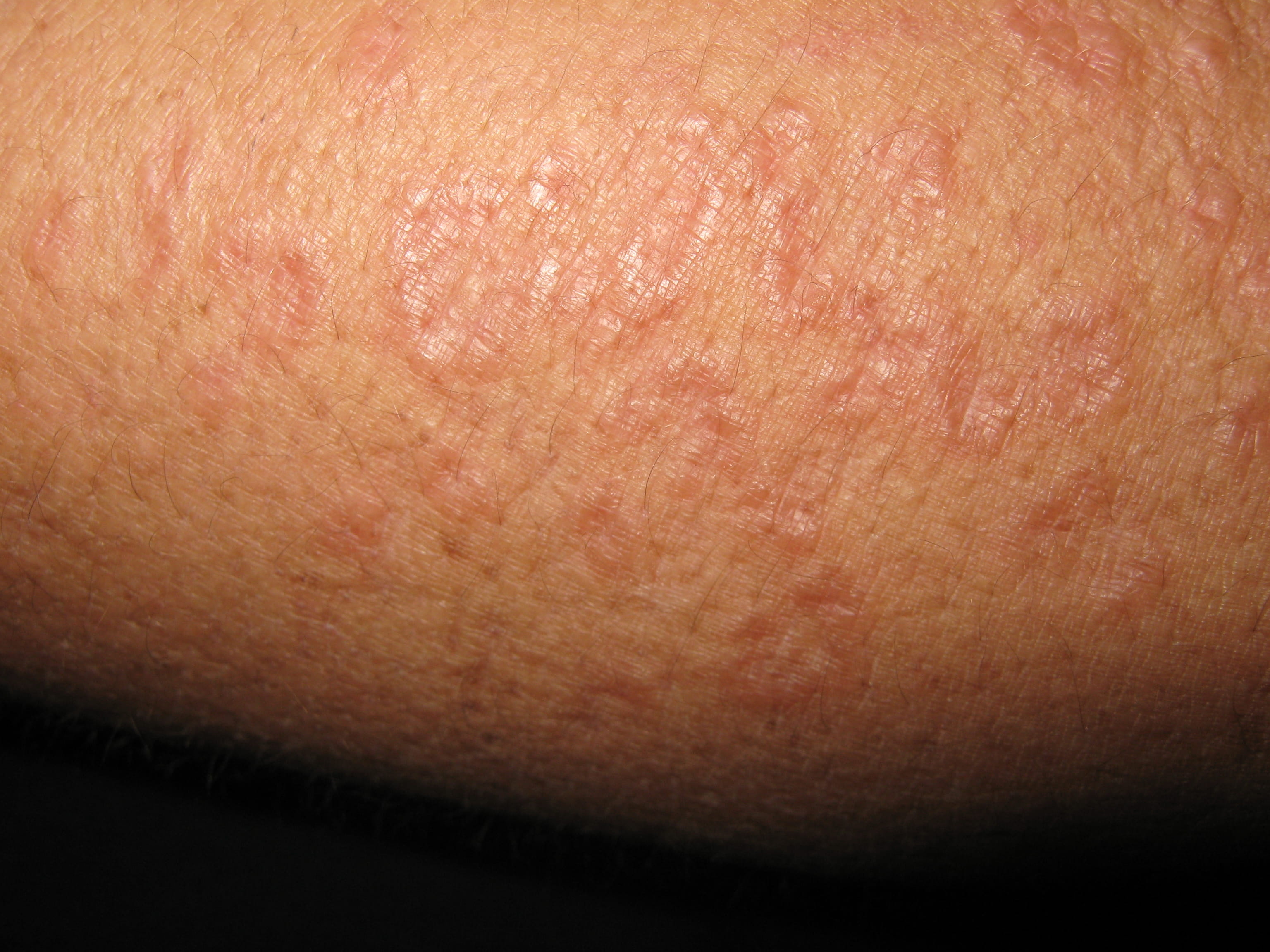 GRANULOMA ANULAR