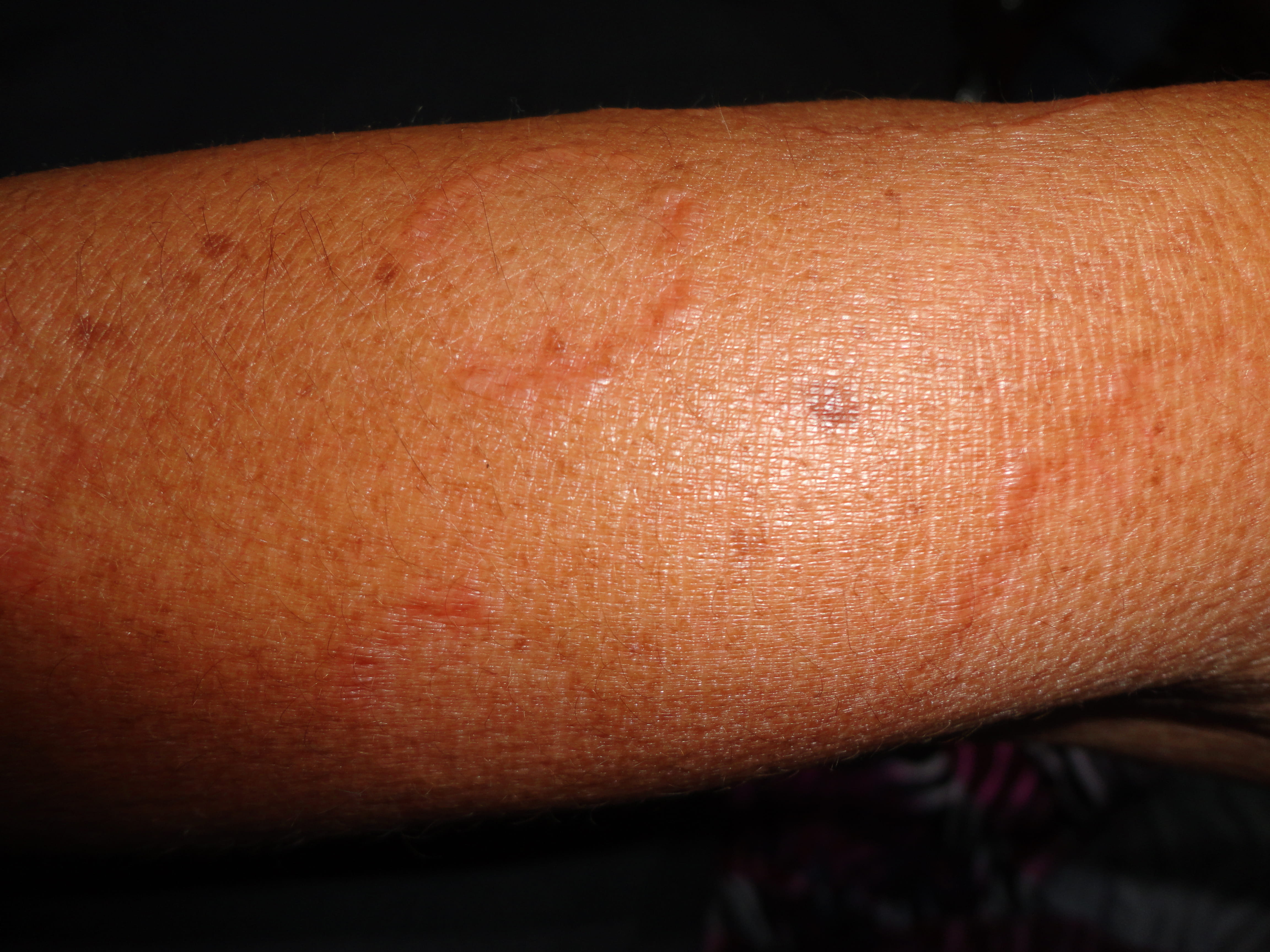 GRANULOMA ANULAR