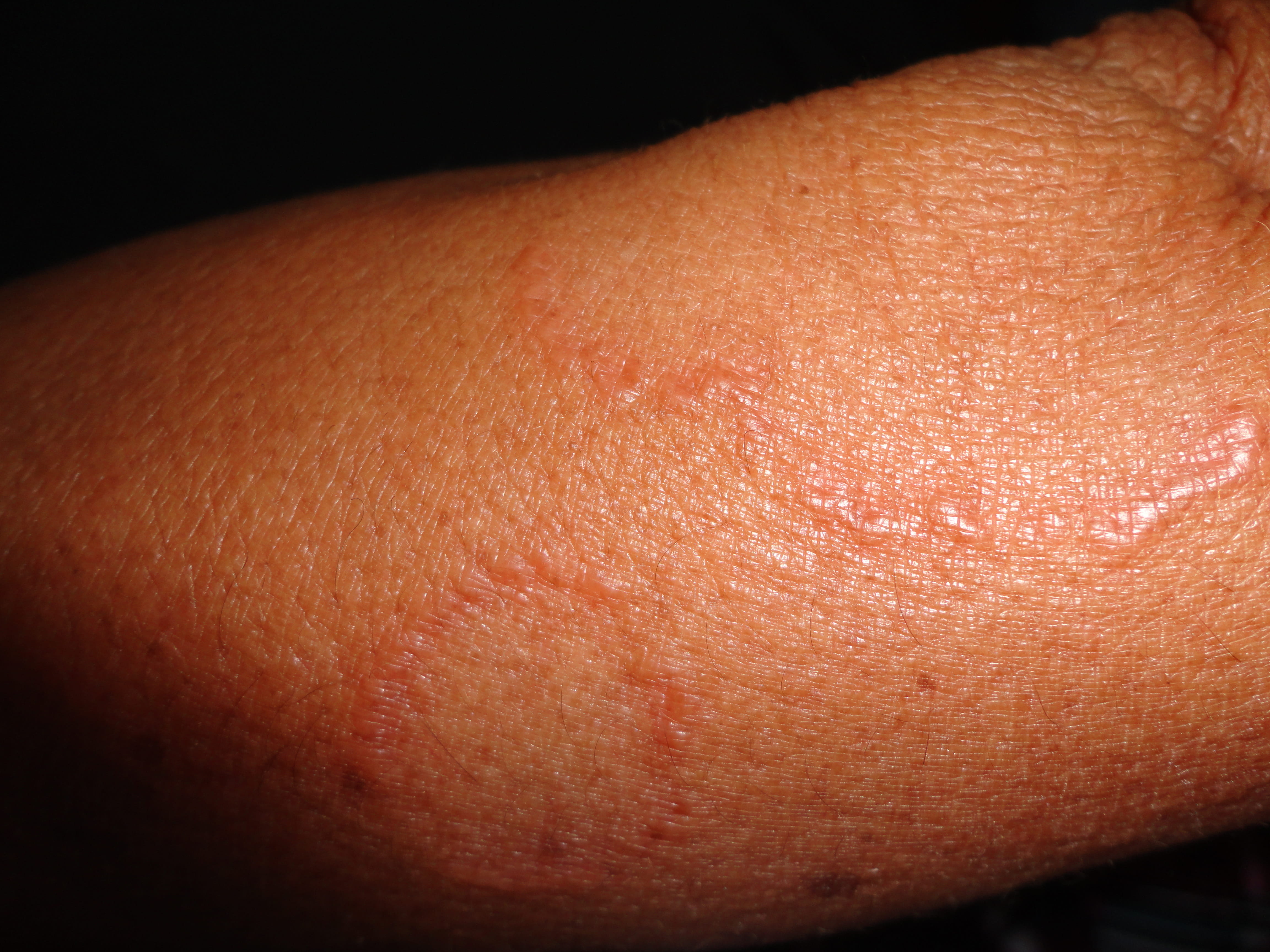 GRANULOMA ANULAR