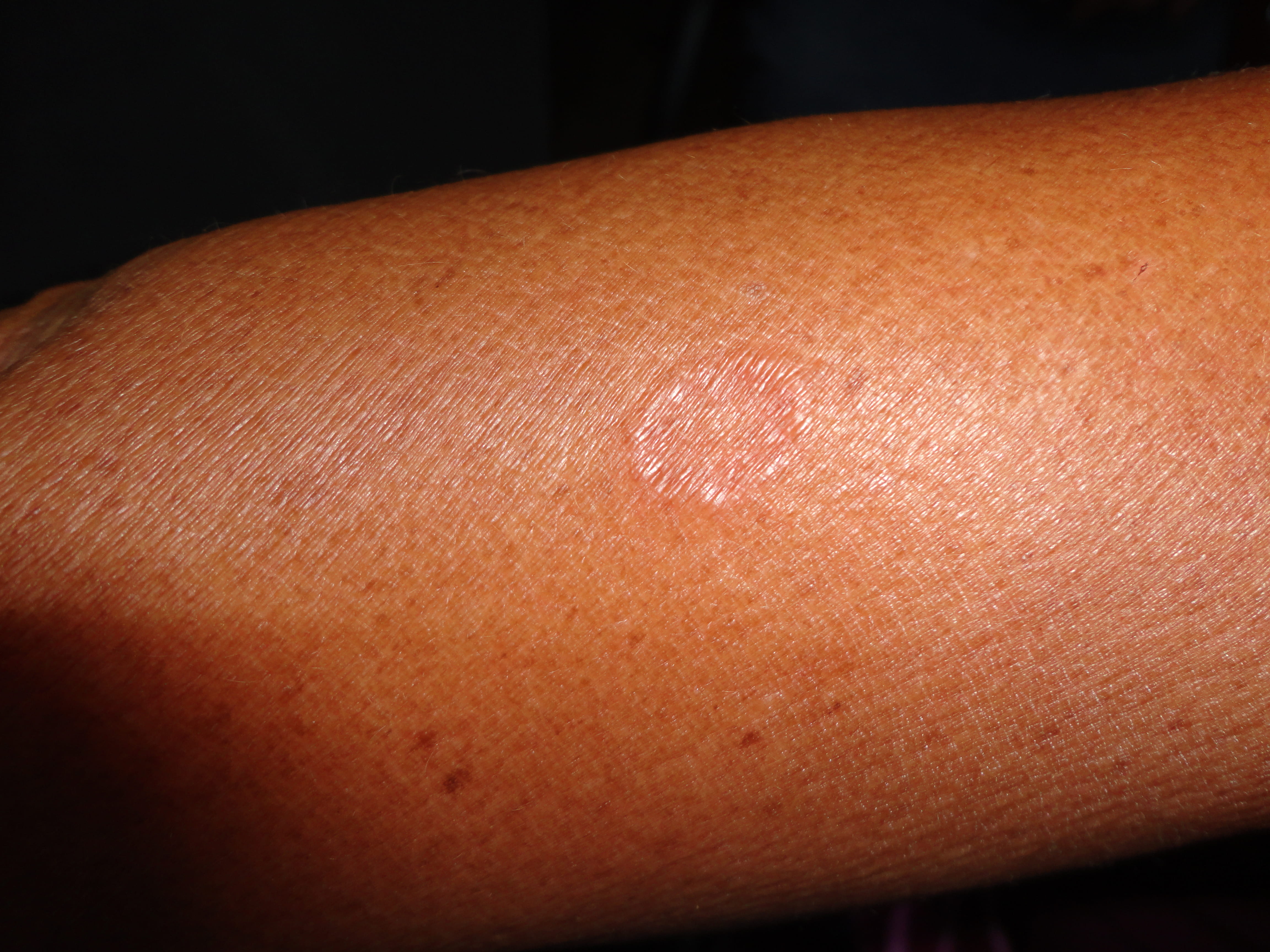 GRANULOMA ANULAR
