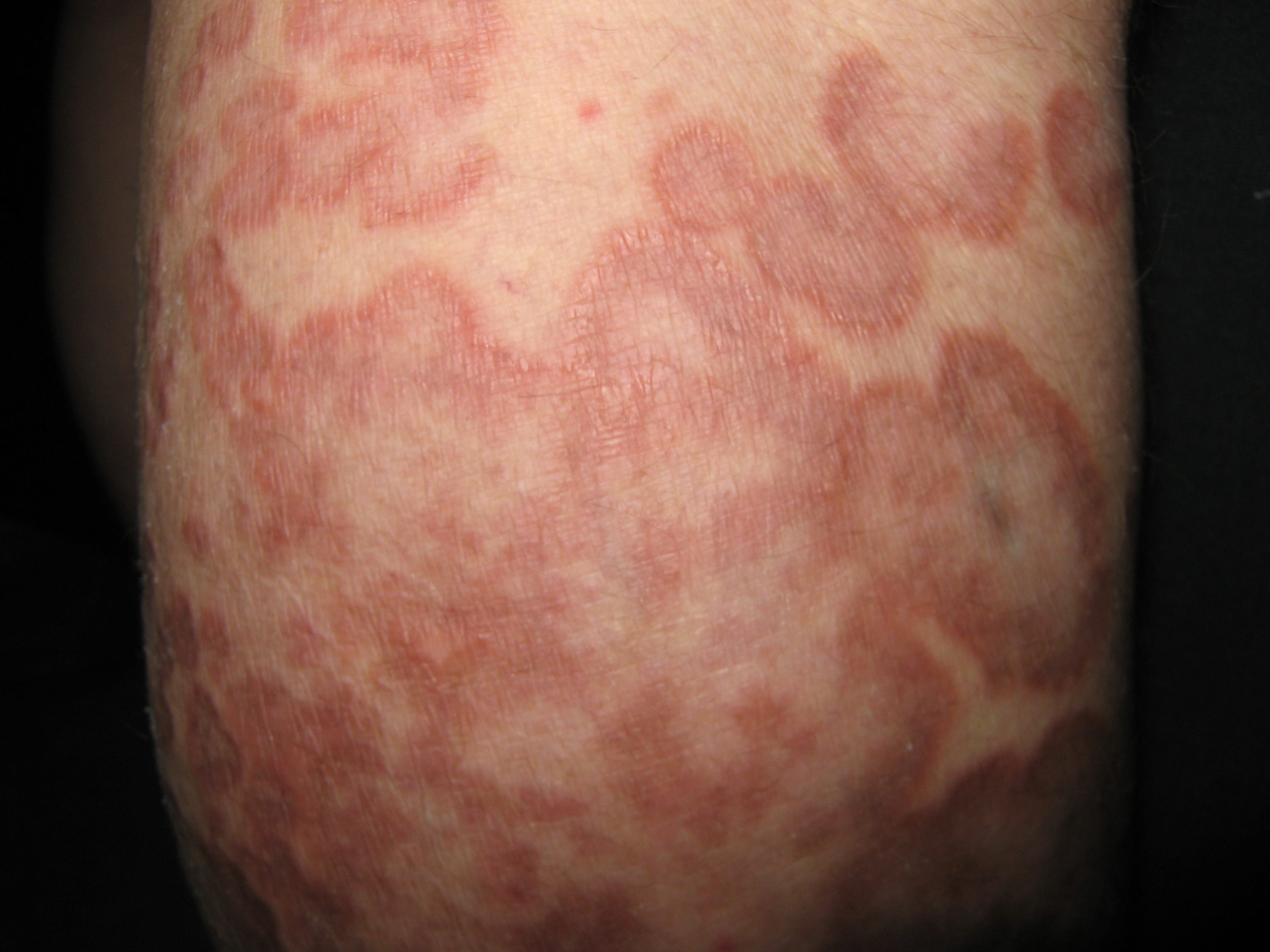 ERITEMA ANULAR