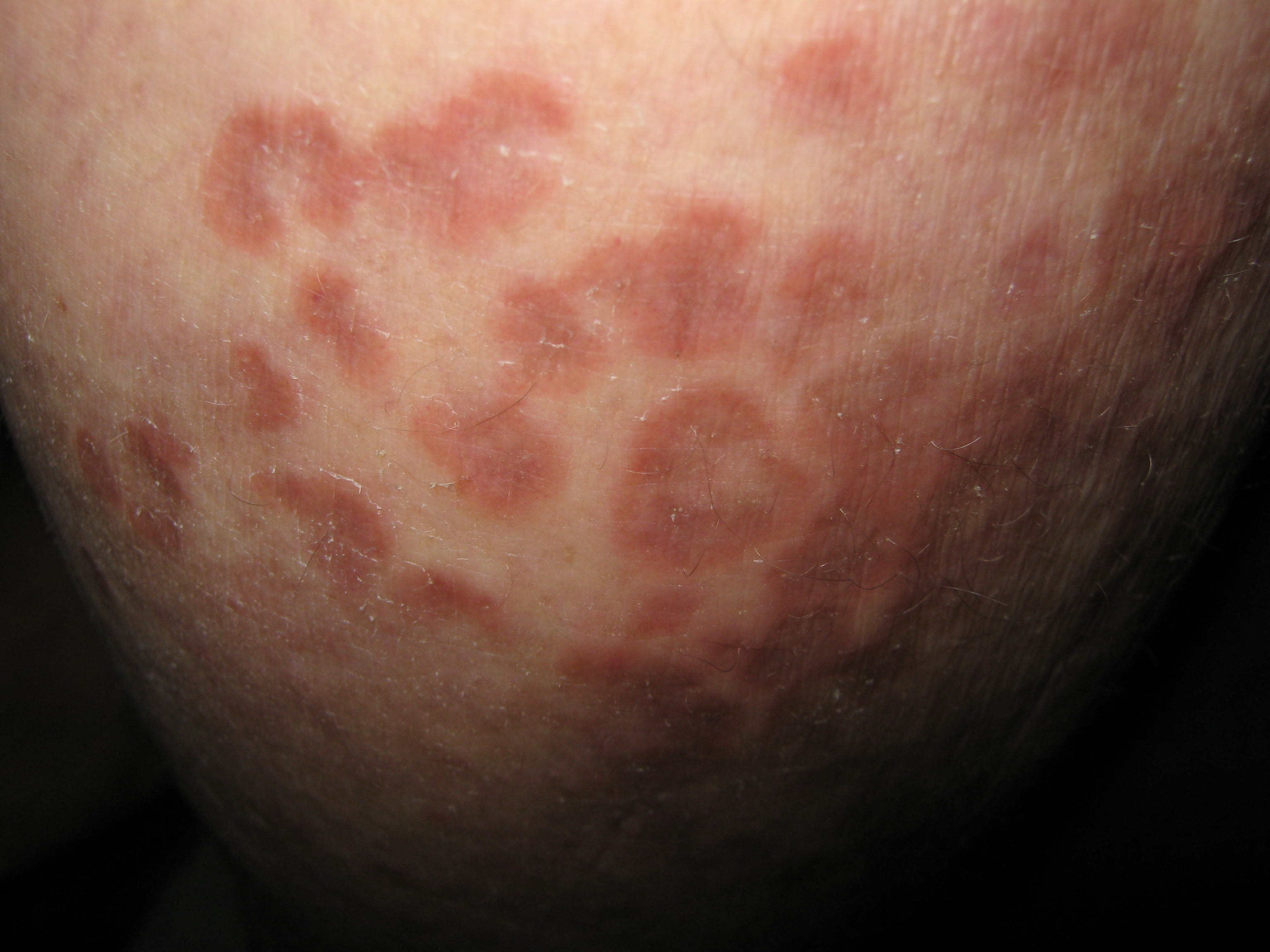 ERITEMA ANULAR