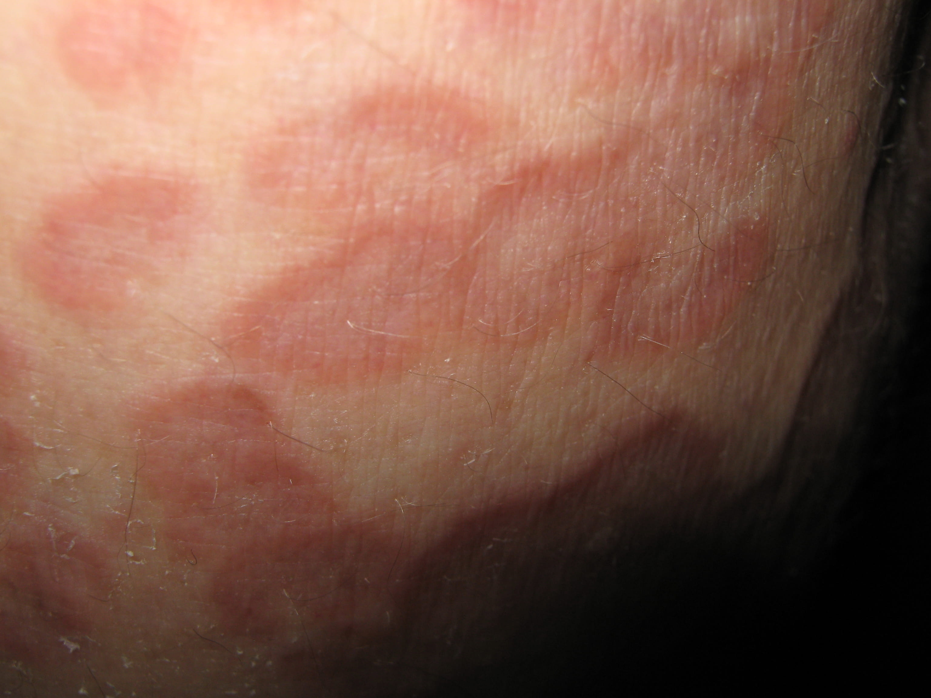 ERITEMA ANULAR