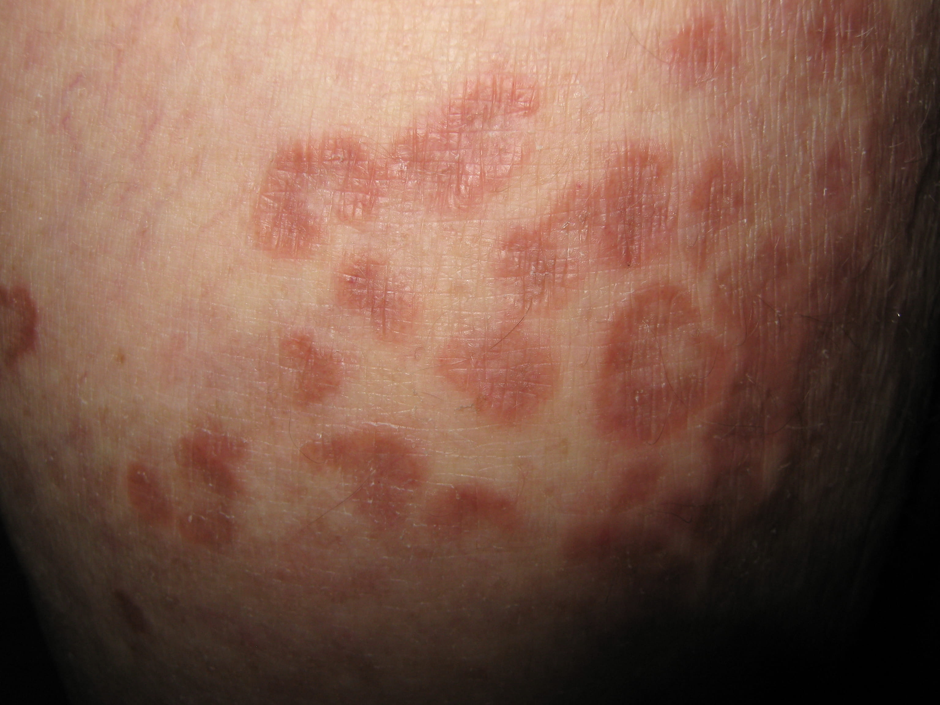 ERITEMA ANULAR