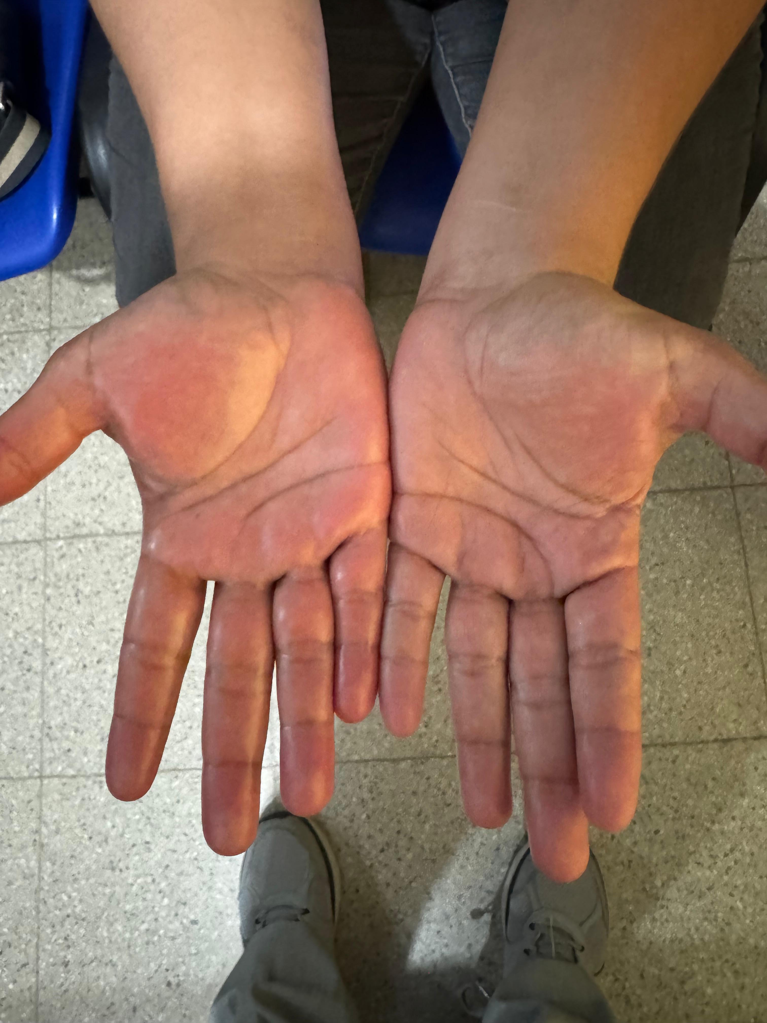 ERITROMELALGIA de las manos