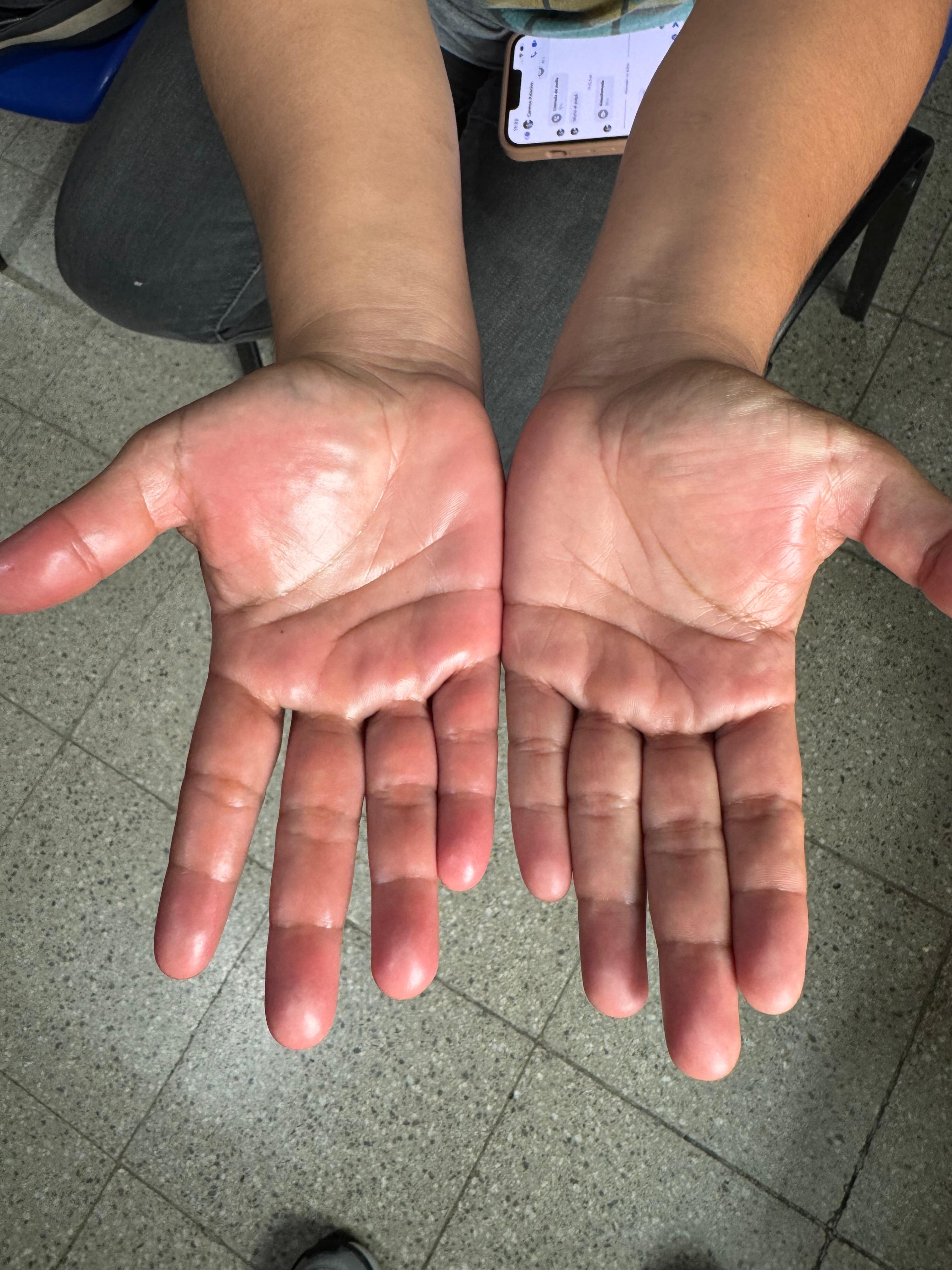 ERITROMELALGIA de las manos