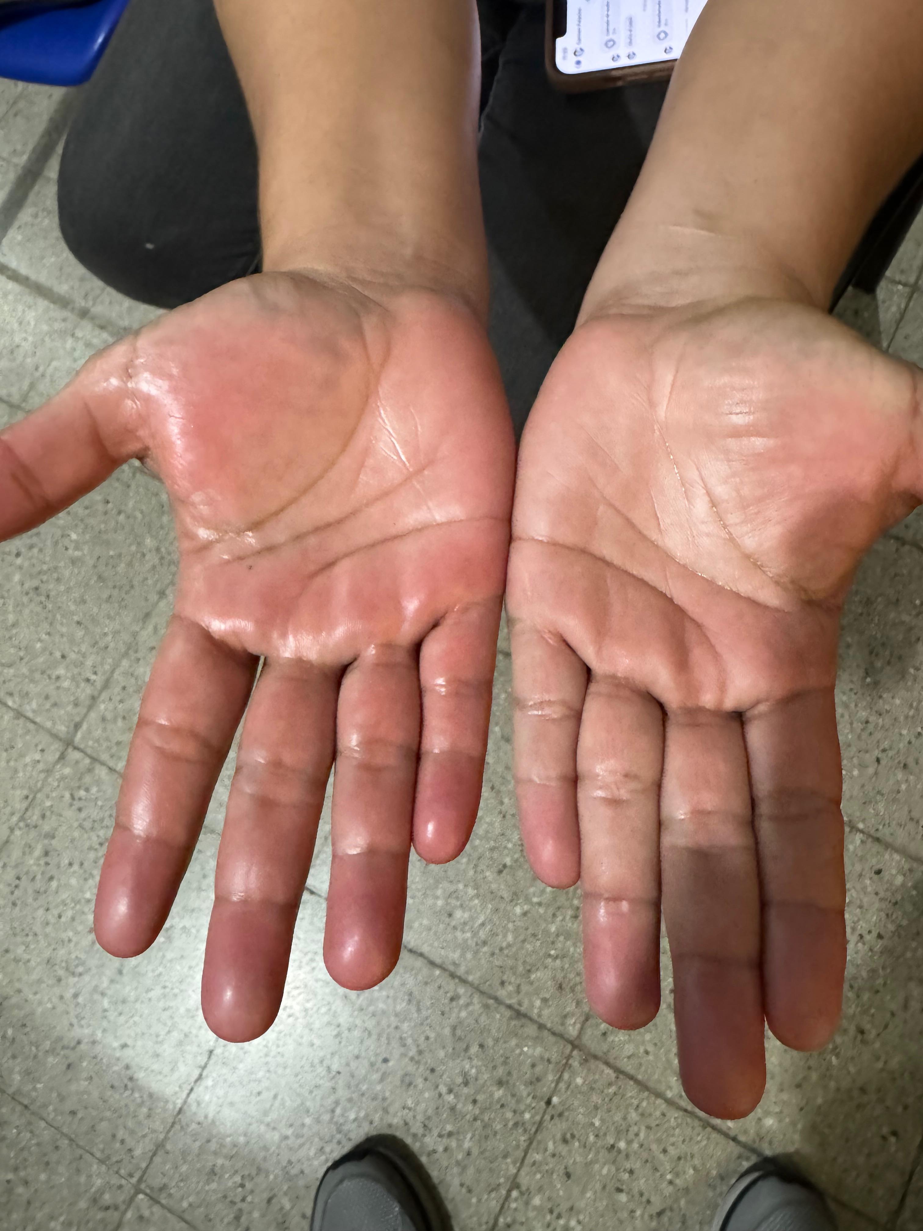 ERITROMELALGIA mano derecha