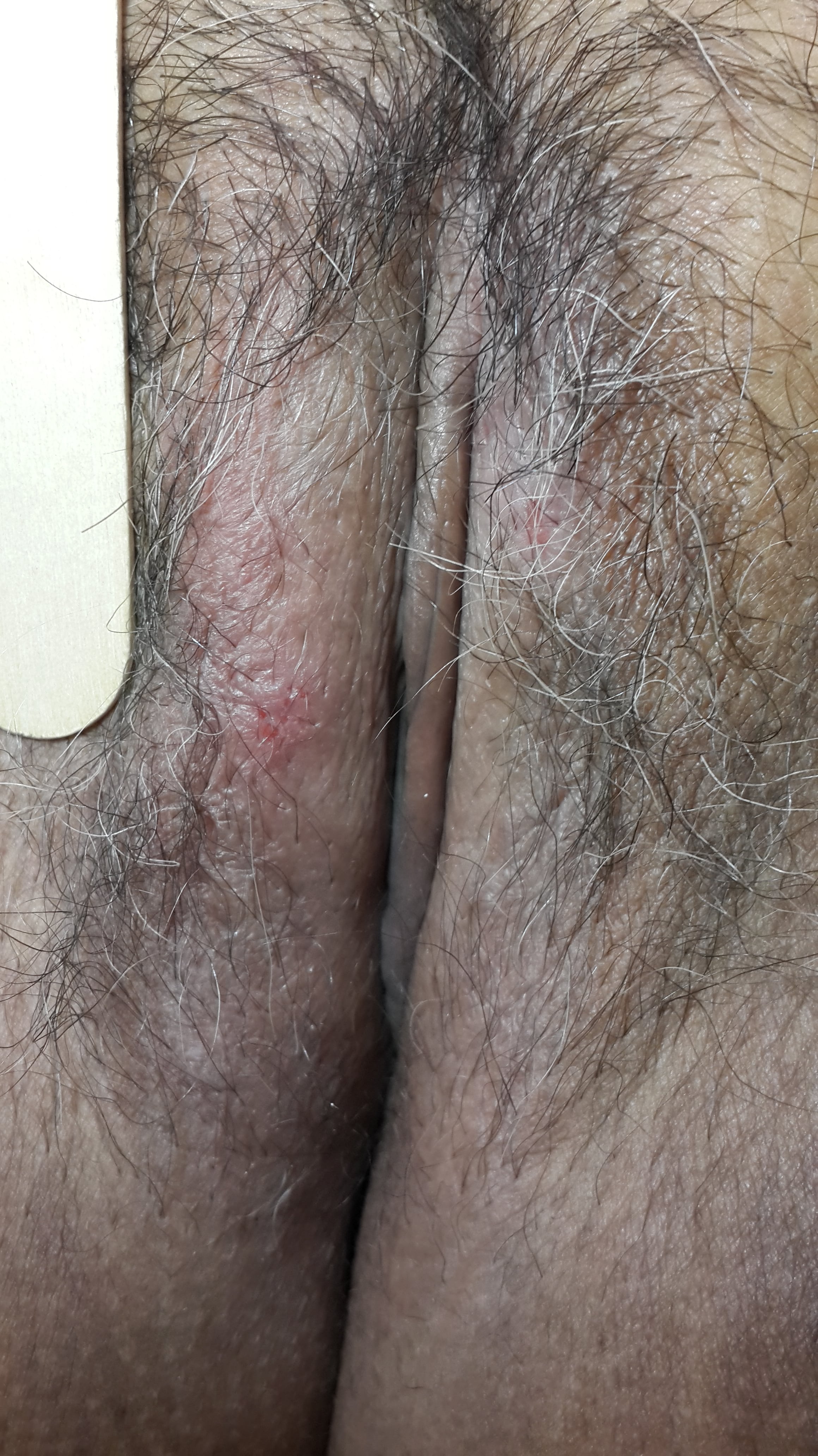 LIQUEN ESCLEROSO Y ATROFICO de la vulva