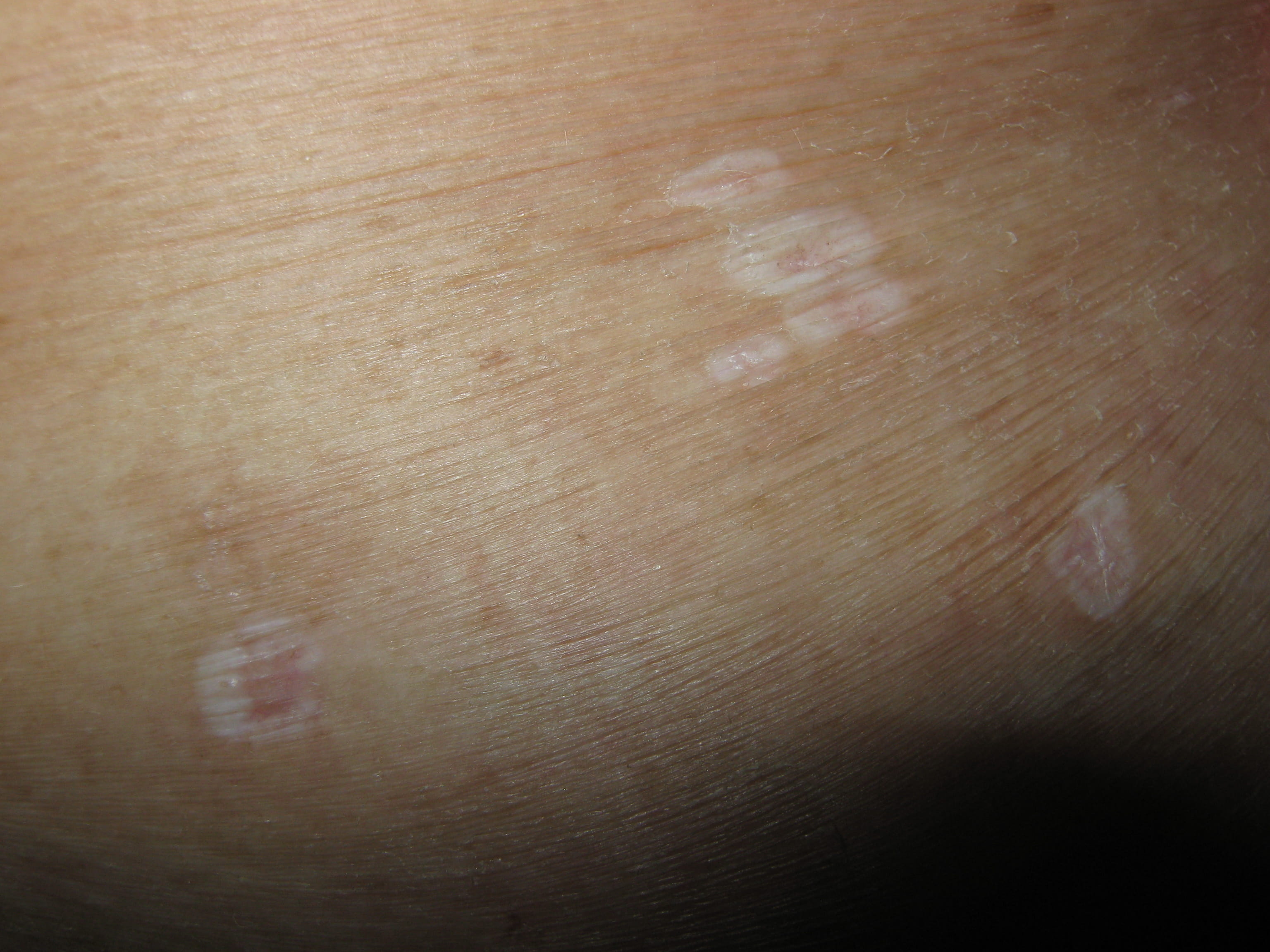 LIQUEN ESCLEROSO Y ATROFICO