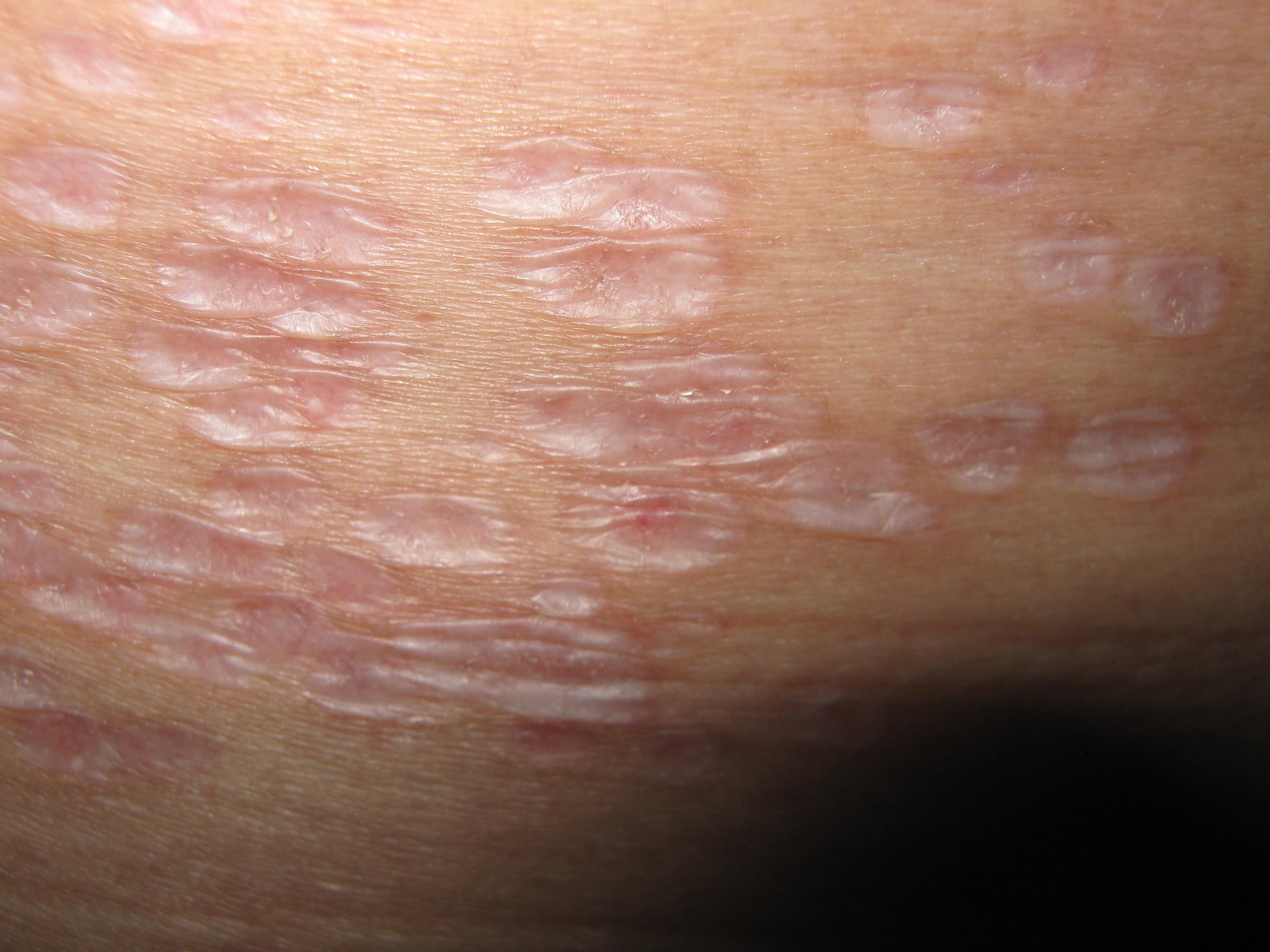 LIQUEN ESCLEROSO Y ATROFICO