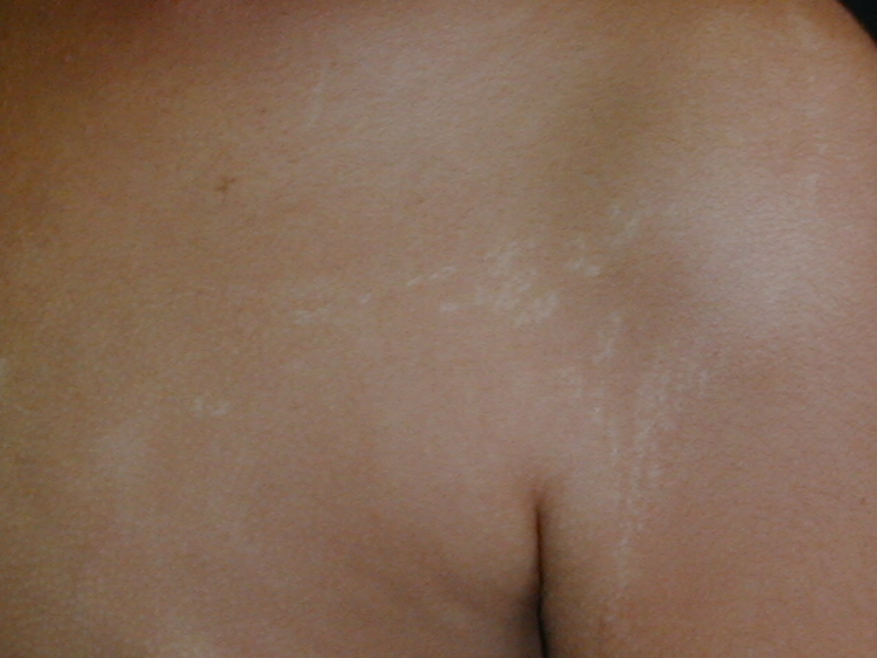 LIQUEN ESTRIADO