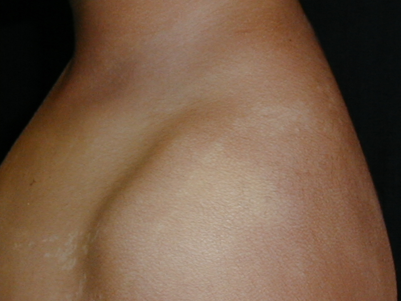 LIQUEN ESTRIADO