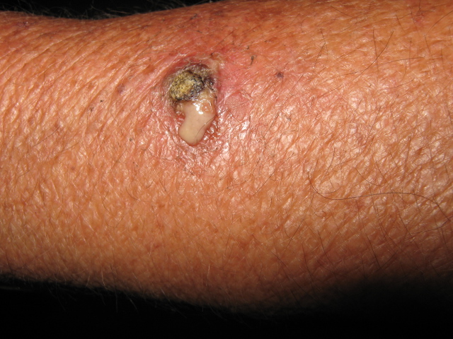 GRANULOMA POR CUERPO EXTRAÑO