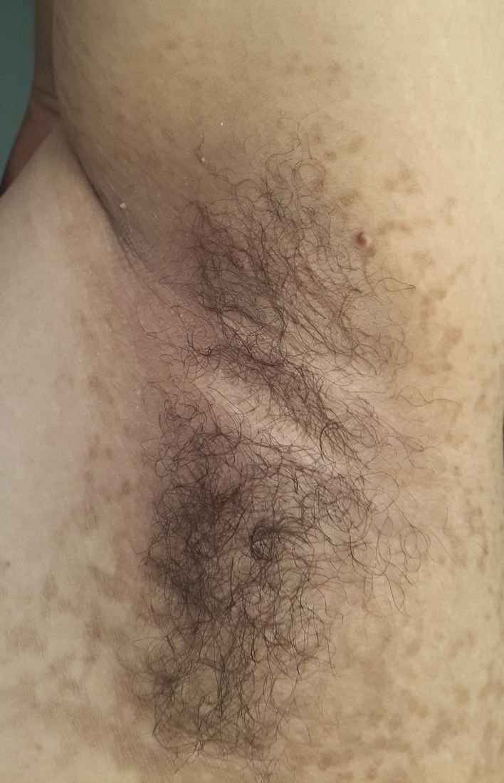 PAPILOMATOSIS RETICULADA