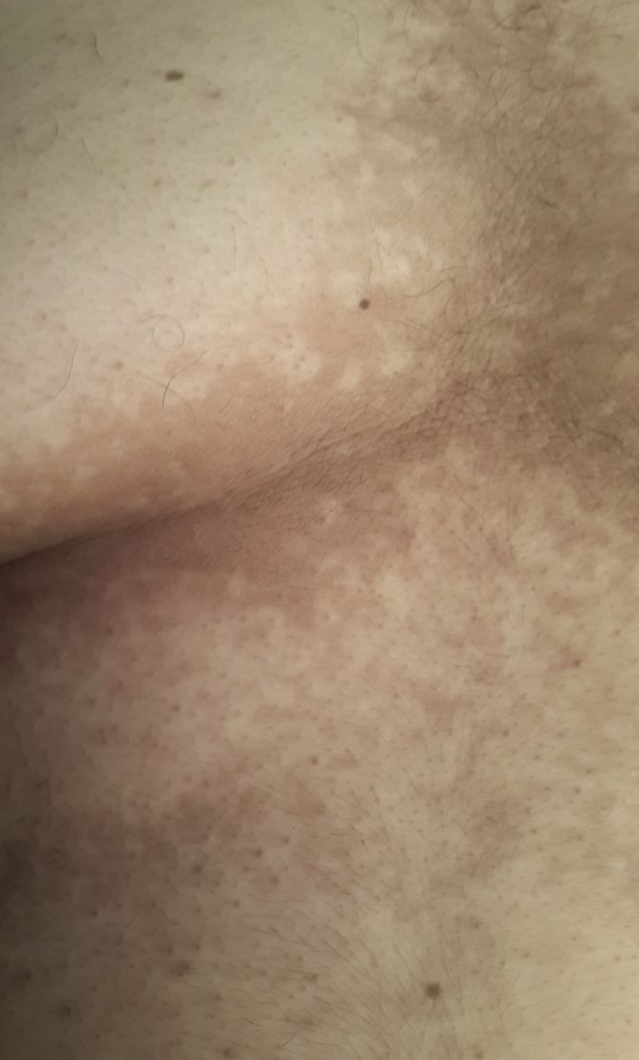 PAPILOMATOSIS RETICULADA