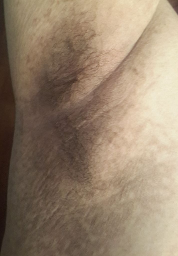 PAPILOMATOSIS RETICULADA